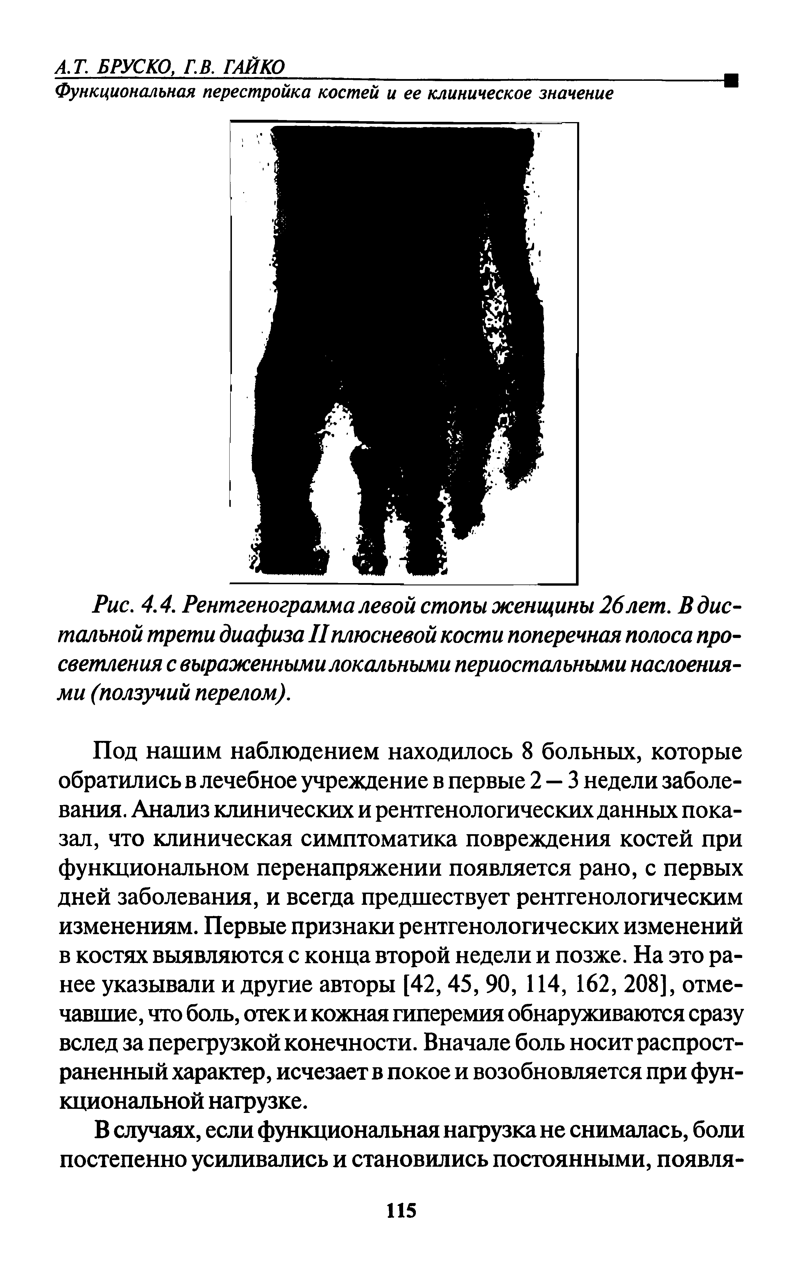 Рис. 4.4. Рентгенограмма левой стопы женщины 26 лет. В дистальной трети диафиза IIплюсневой кости поперечная полоса просветления с выраженными локальными периостальными наслоениями (ползучий перелом).