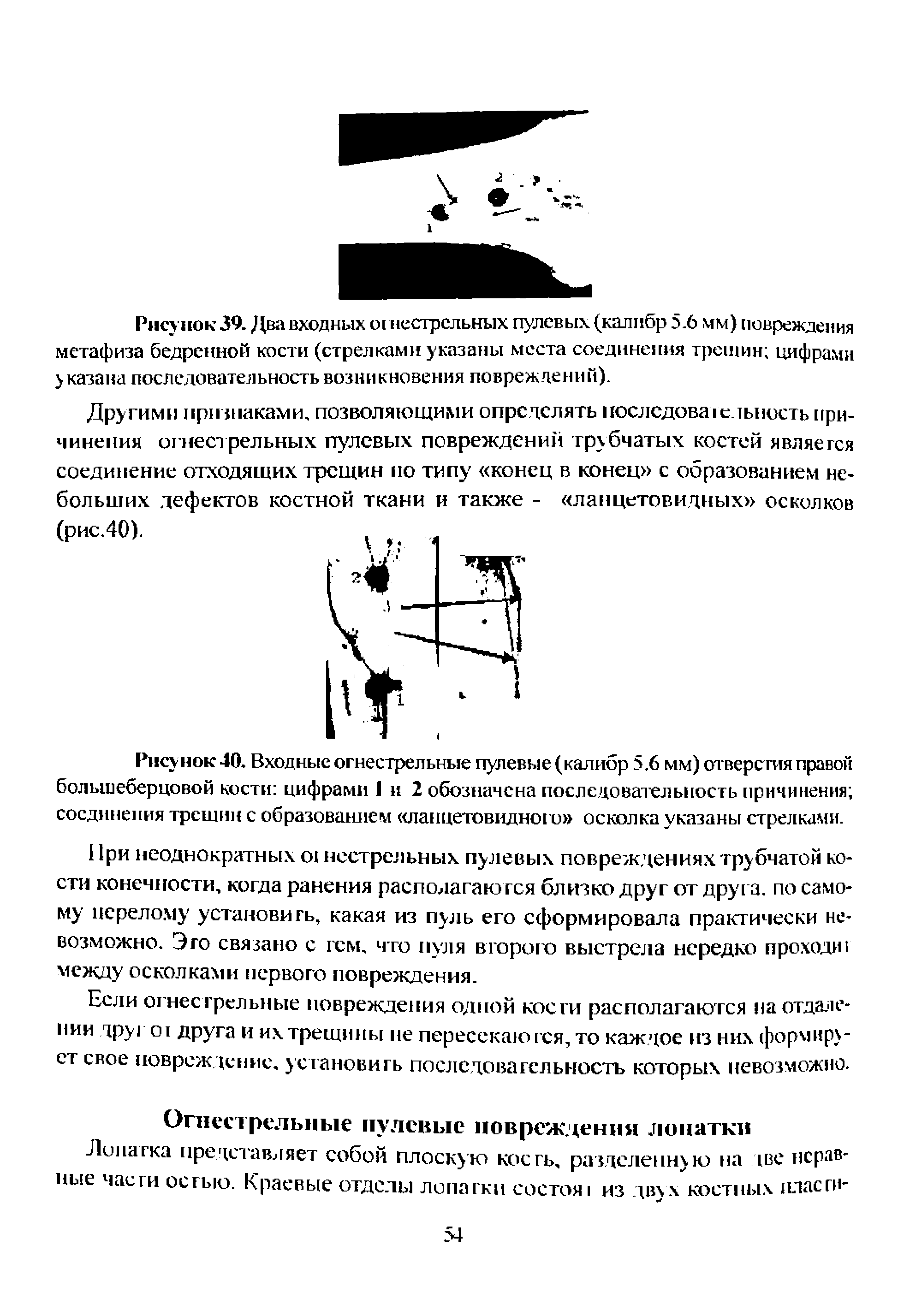 Рисунок 40. Входные огнестрельные пулевые (калибр 5.6 мм) отверстия правой большеберцовой кости цифрами 1 и 2 обозначена последовательность причинения соединения трещин с образованием ланцетовидного осколка указаны стрелками.