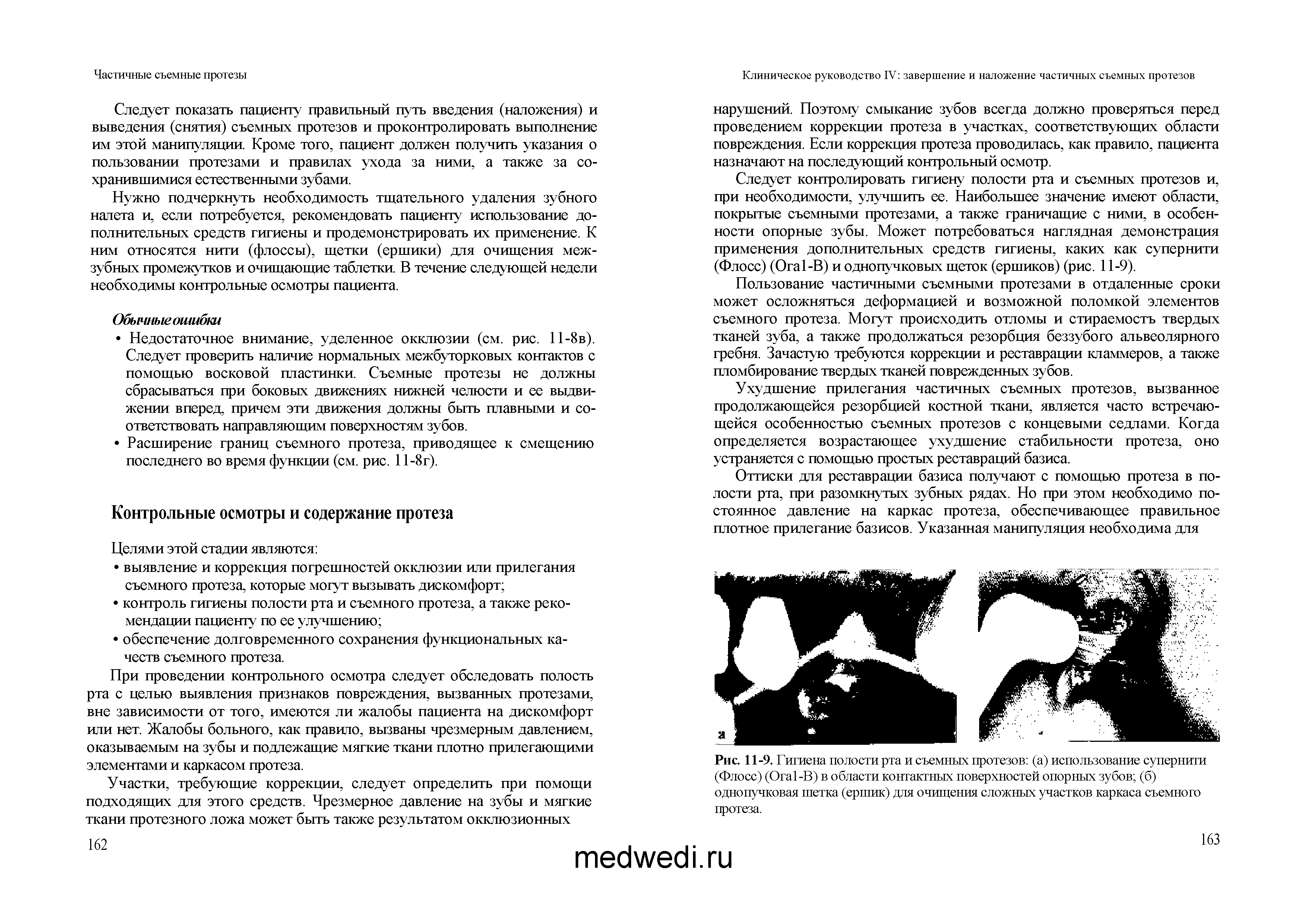 Рис. 11-9. Гигиена полости рта и съемных протезов (а) использование супернити (Флосс) (O -В) в области контактных поверхностей опорных зубов (б) однопучковая шетка (ершик) для очищения сложных участков каркаса съемного протеза.