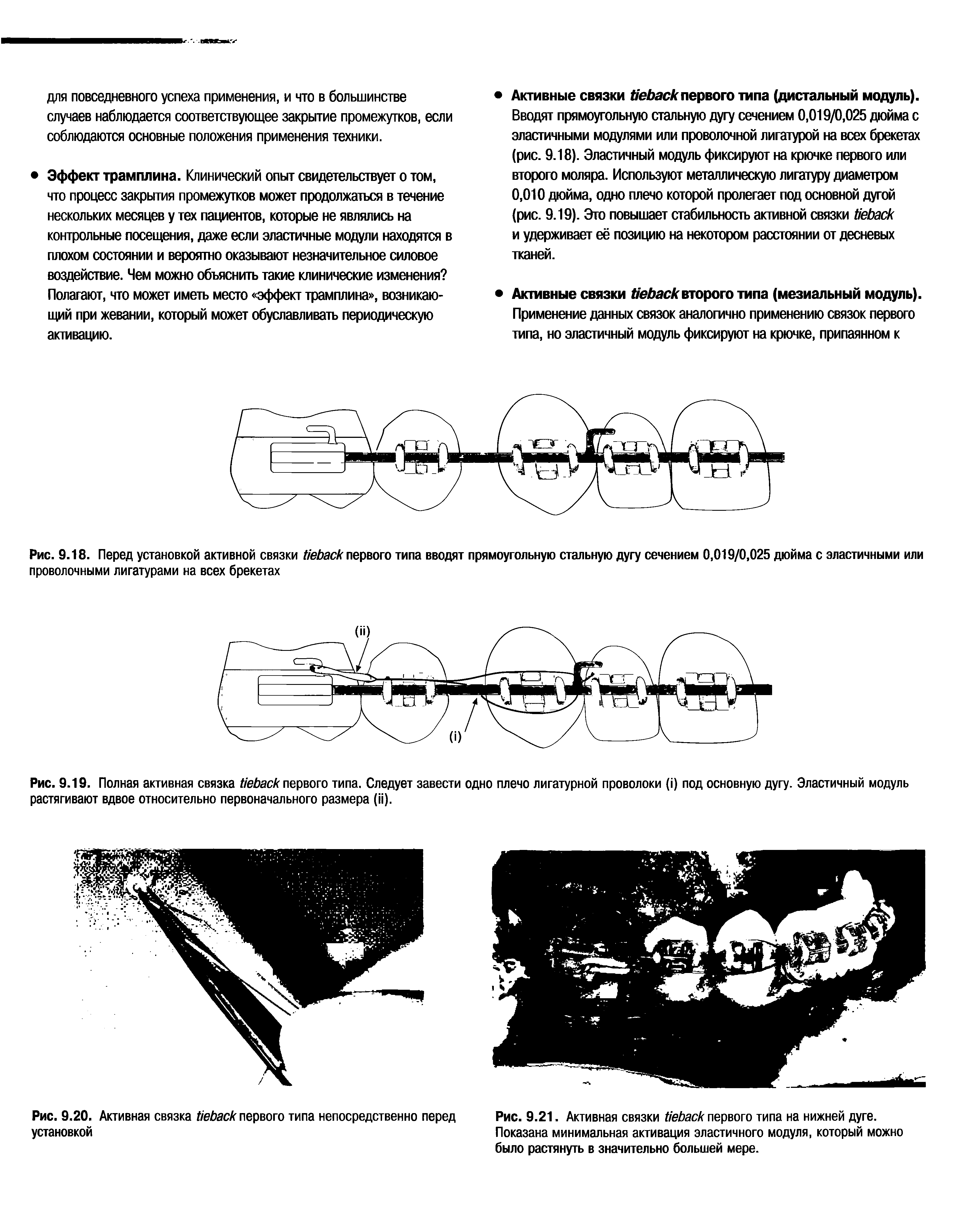 Рис. 9.18. Перед установкой активной связки первого типа вводят прямоугольную стальную дугу сечением 0,019/0,025 дюйма с эластичными или проволочными лигатурами на всех брекетах...