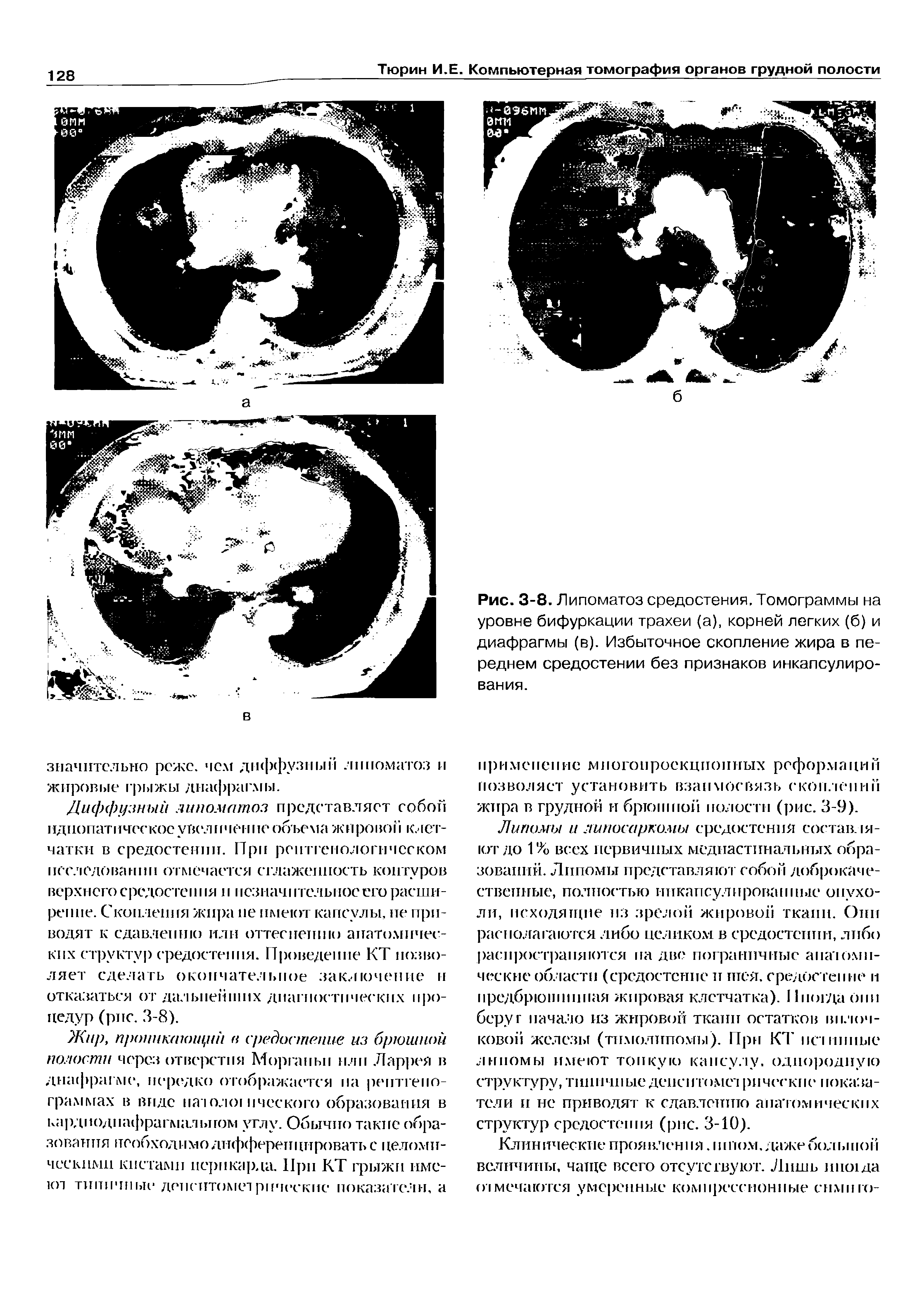 Рис. 3-8. Липоматоз средостения. Томограммы на уровне бифуркации трахеи (а), корней легких (б) и диафрагмы (в). Избыточное скопление жира в переднем средостении без признаков инкапсулирования.