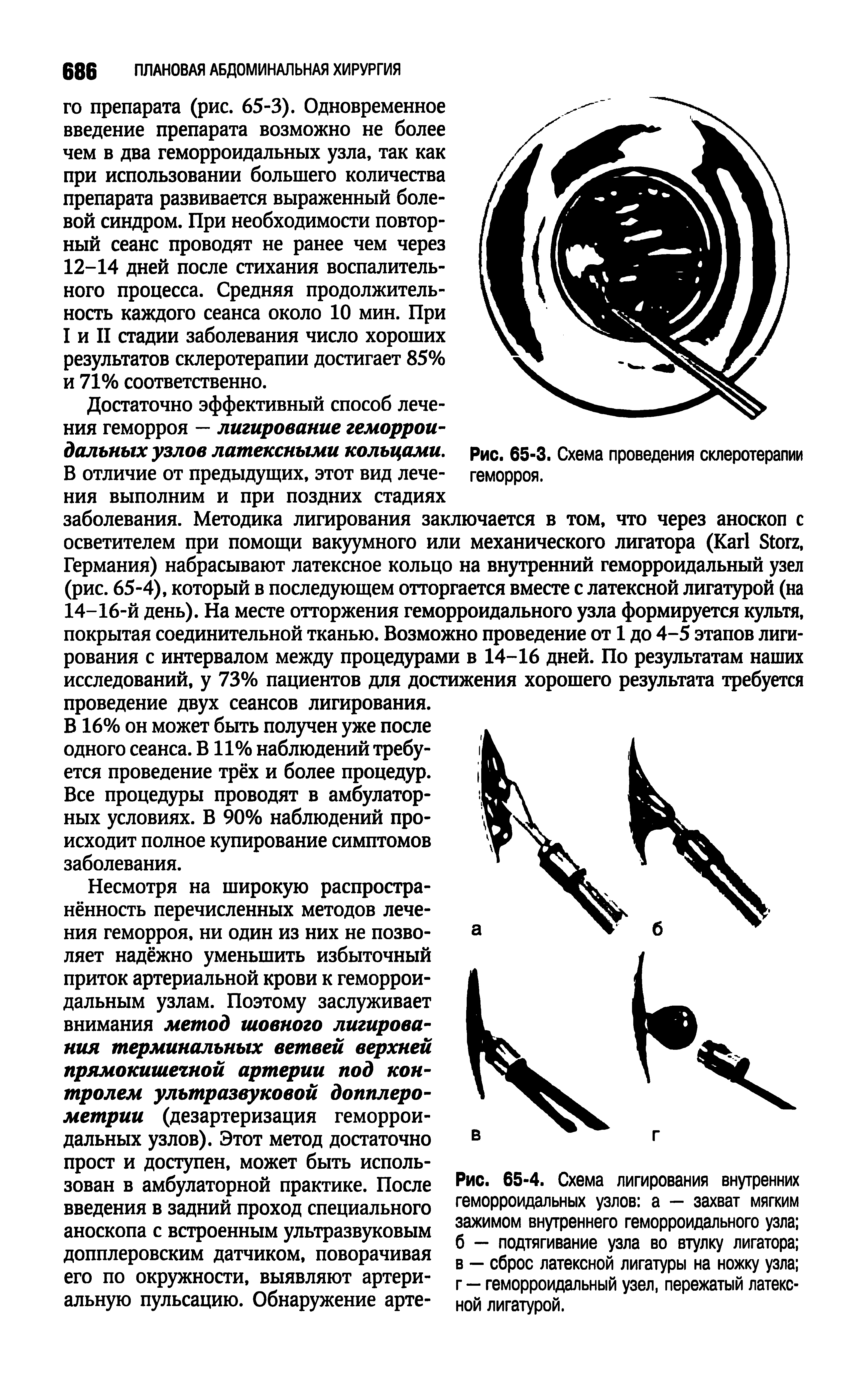 Рис. 65-4. Схема лигирования внутренних геморроидальных узлов а — захват мягким зажимом внутреннего геморроидального узла б — подтягивание узла во втулку лигатора в — сброс латексной лигатуры на ножку узла г — геморроидальный узел, пережатый латексной лигатурой.