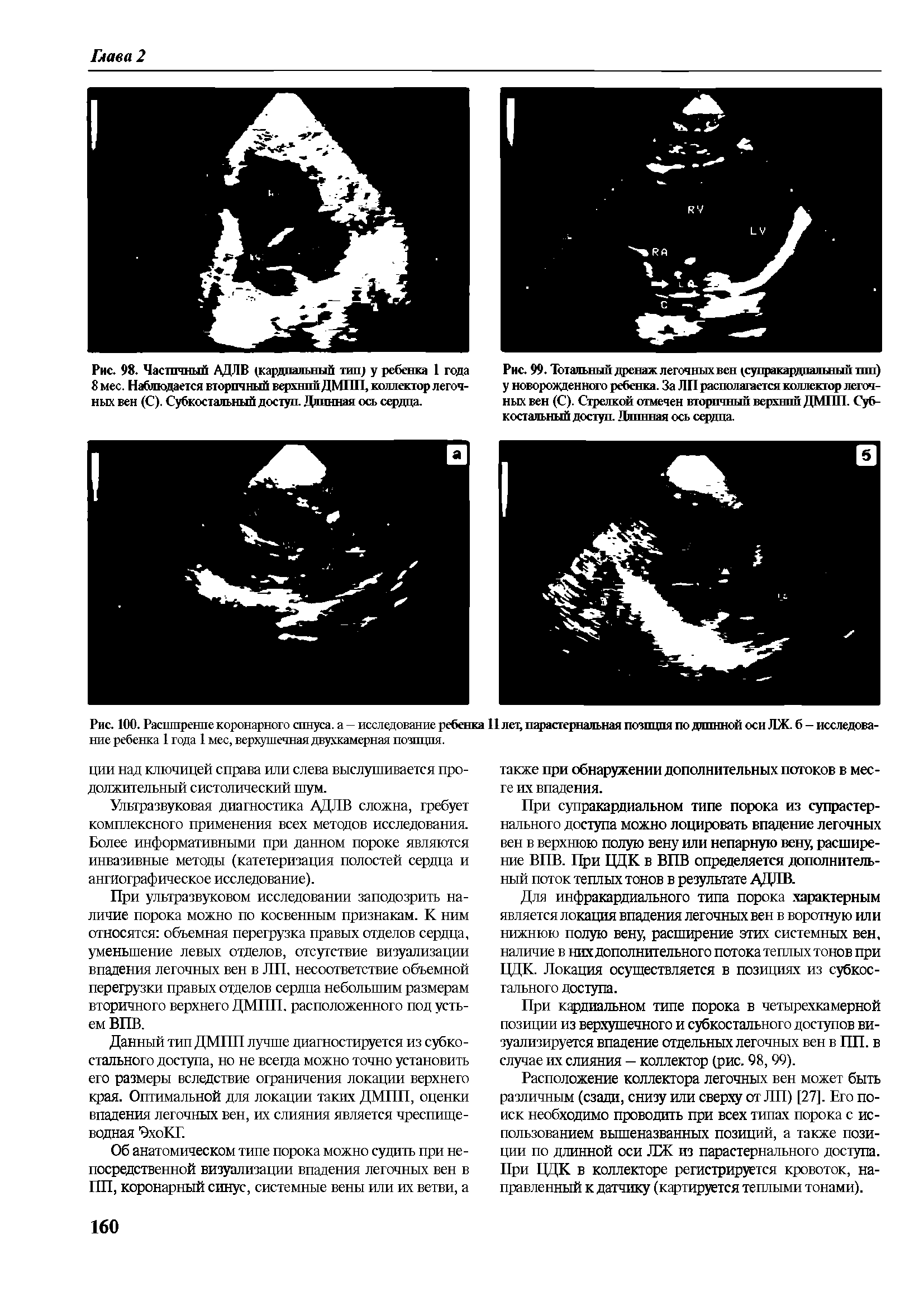 Рис. 98. Частичный АДЛВ (кардиальный тип) у ребенка 1 года 8 мес. Наблюдается вторичный верхний ДМПП, коллектор легочных вен (С). Субкостальный доступ. Длинная ось серд ца.