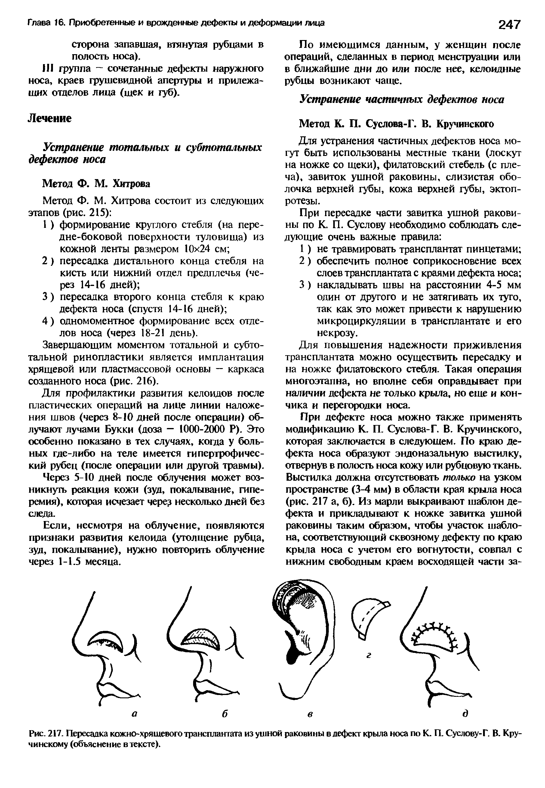 Рис. 217. Пересадка кожно-хрящевого трансплантата из ушной раковины в дефект крыла носа по К. П. Суслову-Г. В. Кру-чинскому (объяснение в тексте).