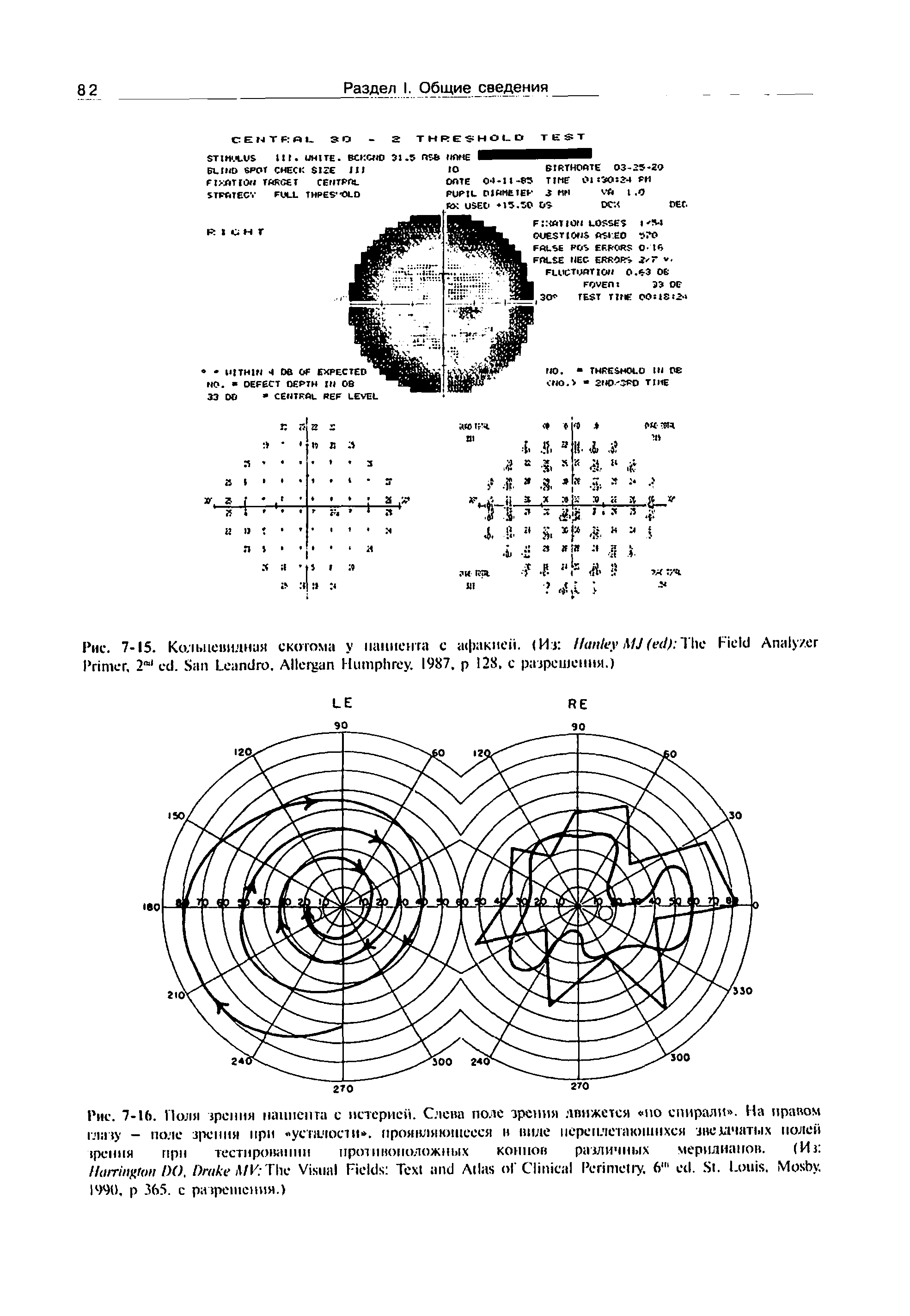 Рис. 7-16. Поля зрения нацией та с истерией. Слева поле зрения движется глазу - поле зрения при усталости , зрения при тестировании противоположных...