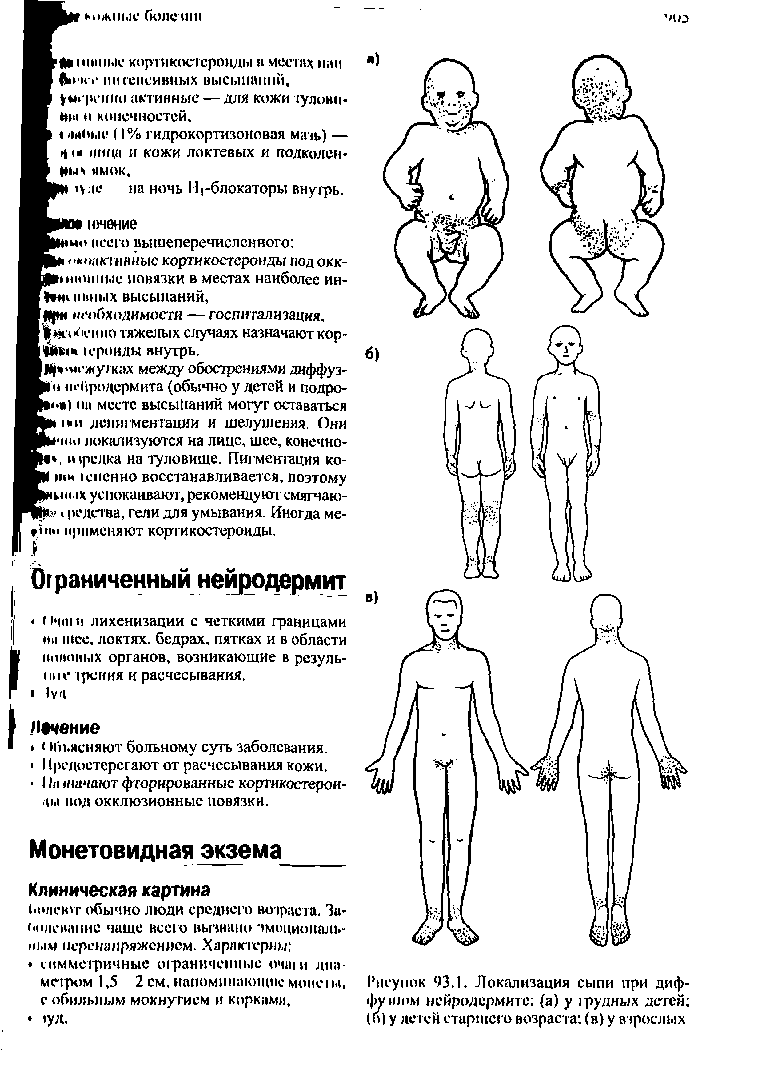 Рисунок 93.1. Локализация сыпи при диффузном нейродермите (а) у грудных детей (б) у детей старшего возраста (в) у взрослых...