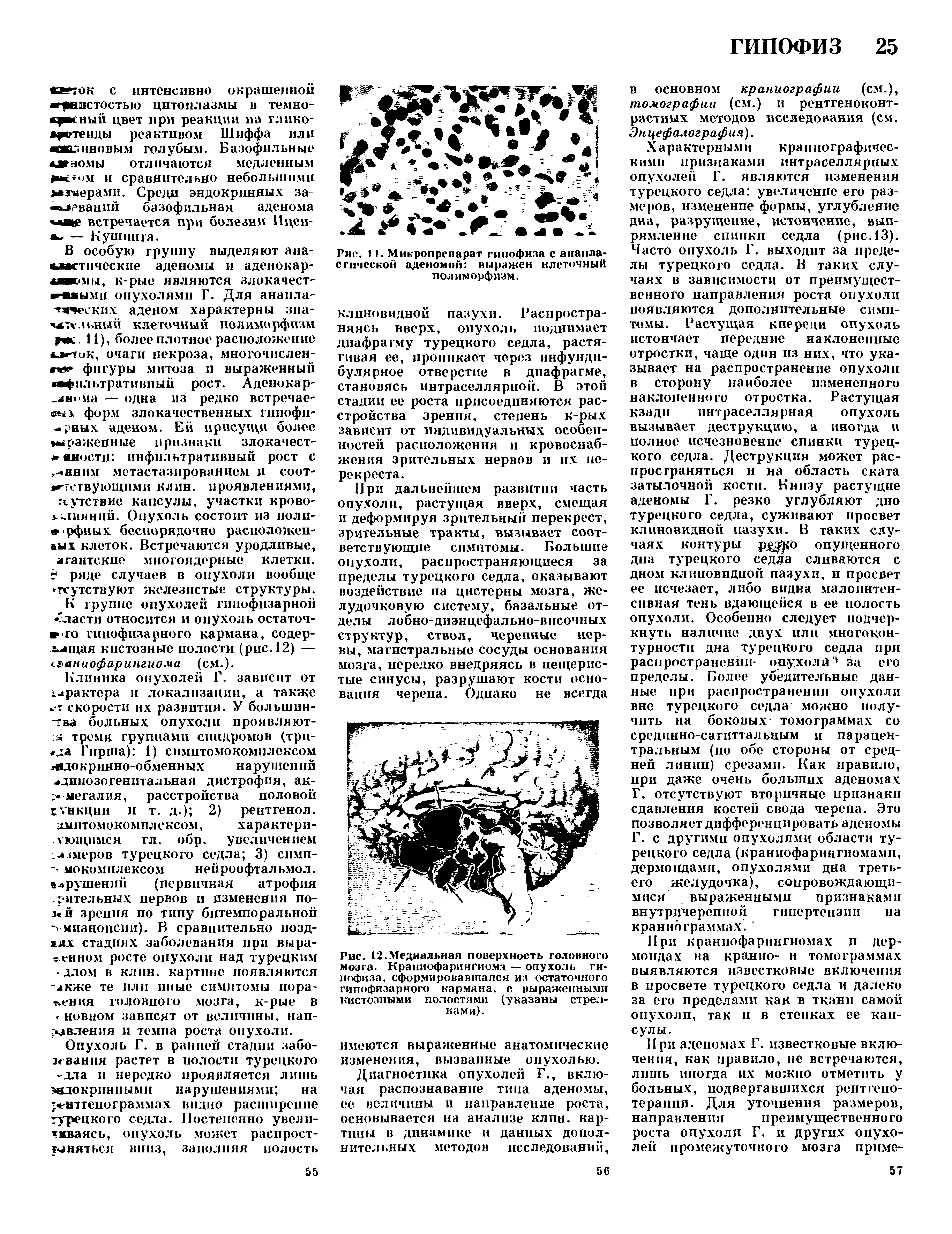 Рис. 12.Медиальная поверхность головного мозга- Краниофарингиома — опухоль гипофиза, сформировавшаяся из остаточного гипофизарного кармана, с выраженными кистозными полостями (указаны стрелками).