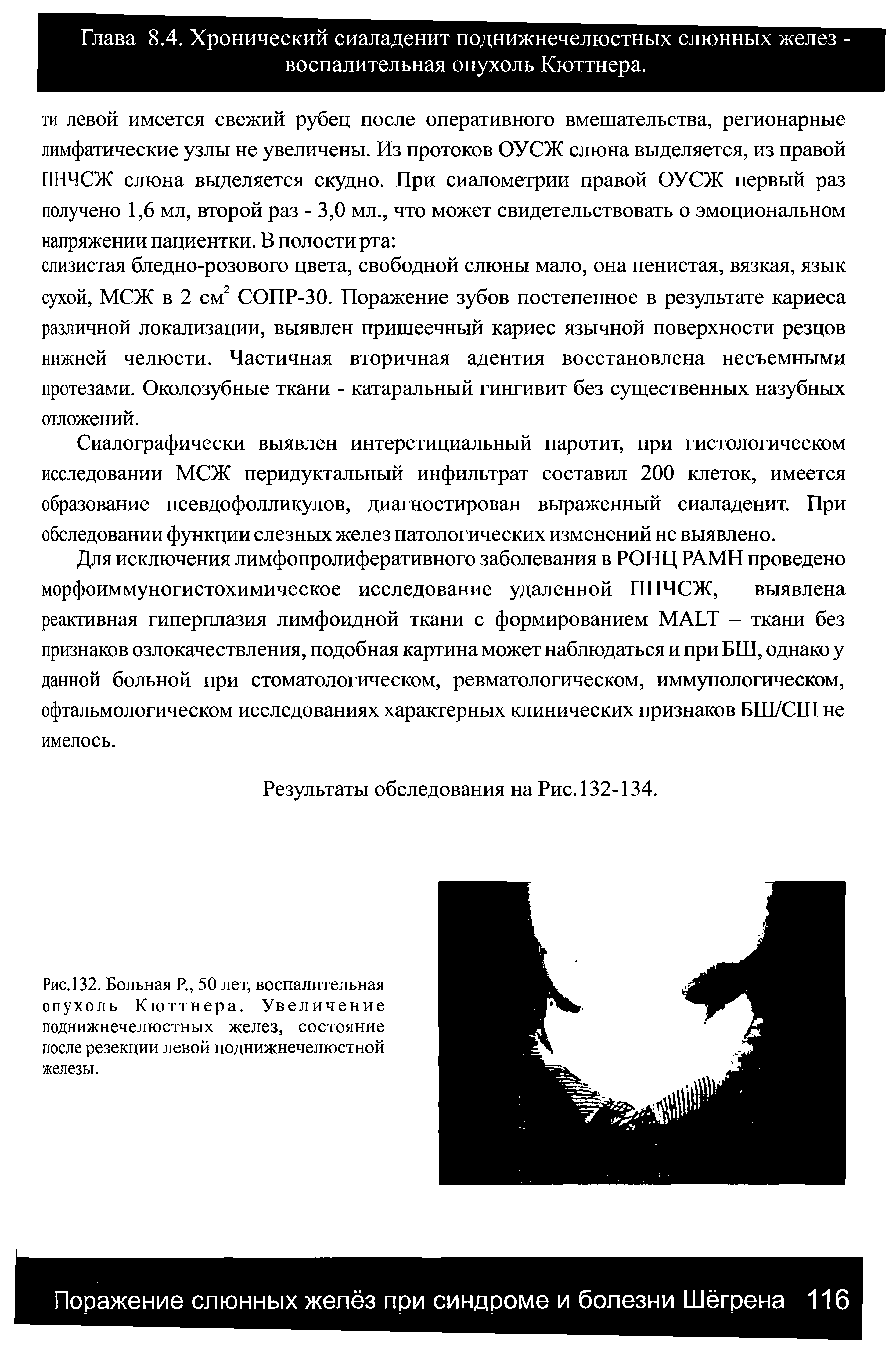 Рис. 132. Больная Р., 50 лет, воспалительная опухоль Кюттнера. Увеличение поднижнечелюстных желез, состояние после резекции левой поднижнечелюстной железы.