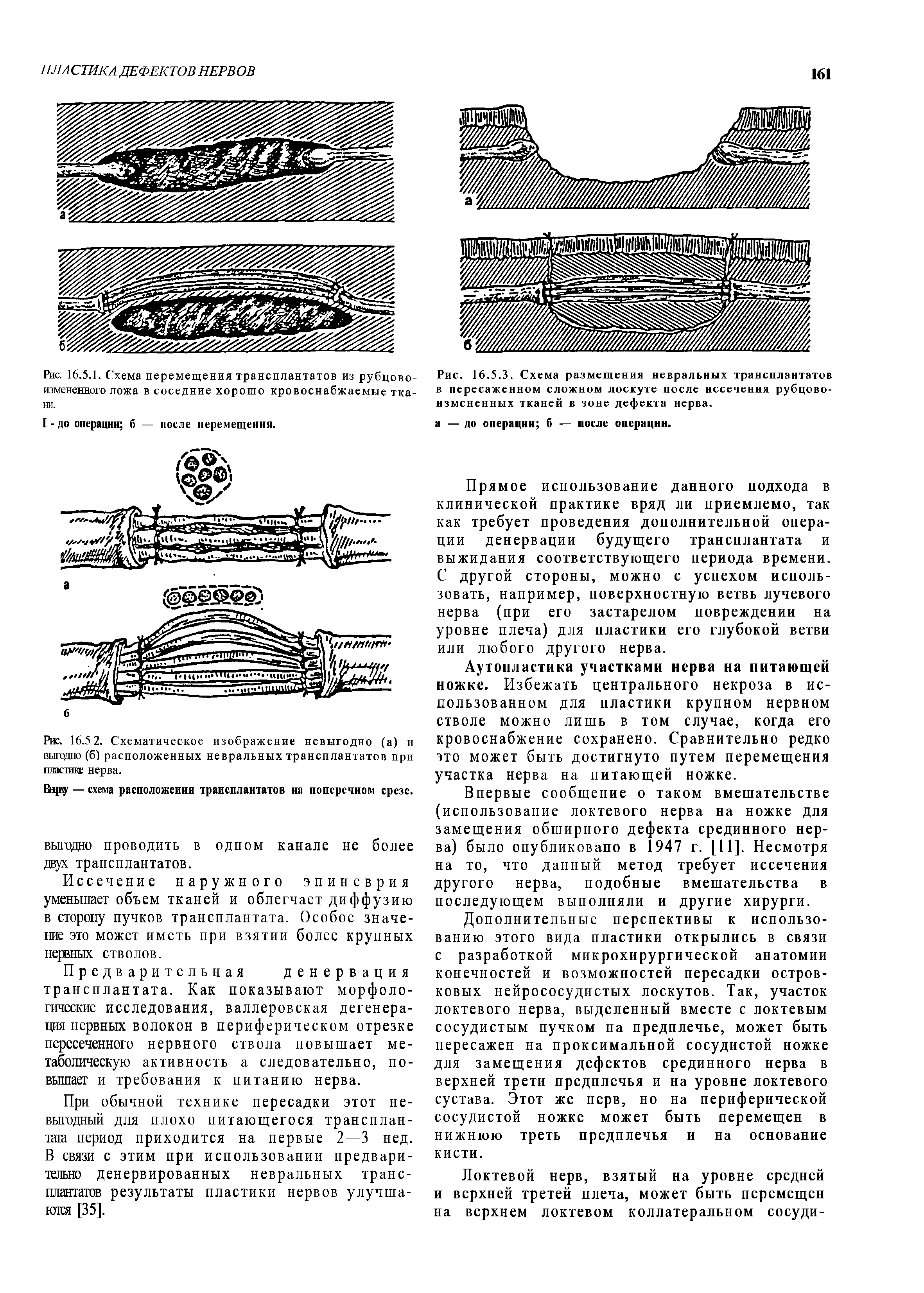 Рис. 16.5 2. Схематическое изображение невыгодно (а) и выгодно (б) расположенных невральных трансплантатов при пластике нерва.