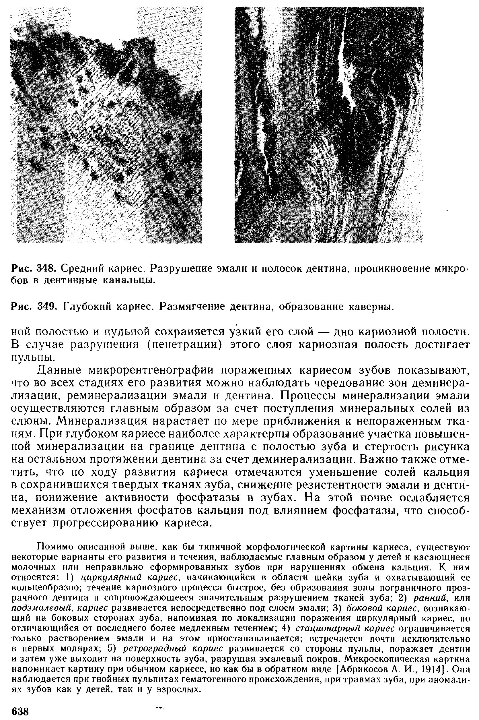 Рис. 349. Глубокий кариес. Размягчение дентина, образование каверны, ной полостью и пульпой сохраняется узкий его слой — дно кариозной полости. В случае разрушения (пенетрации) этого слоя кариозная полость достигает пульпы.