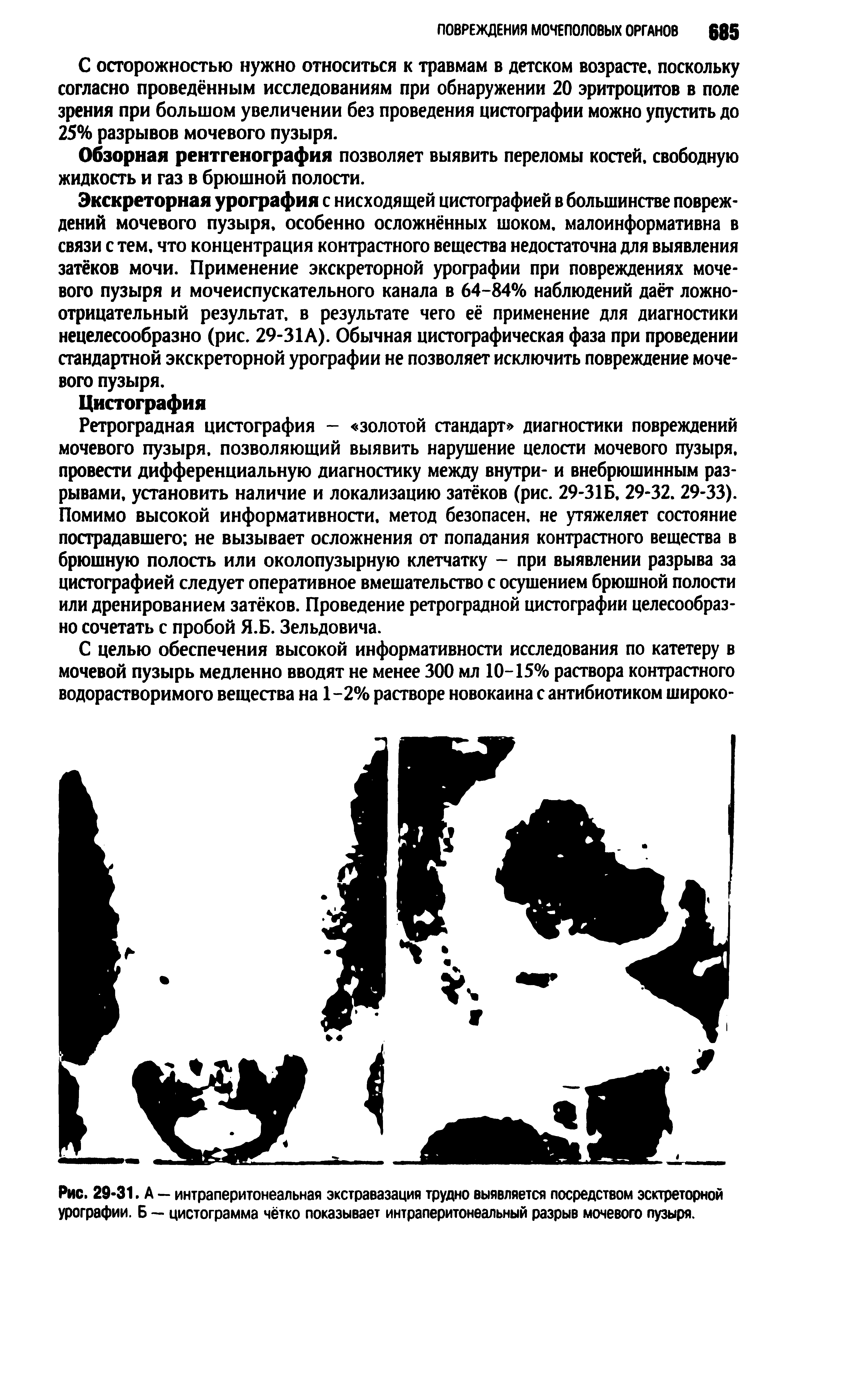 Рис. 29-31. А — интраперитонеальная экстравазация трудно выявляется посредством эсктреторной урографии. Б — цистограмма чётко показывает интраперитонеальный разрыв мочевого пузыря.