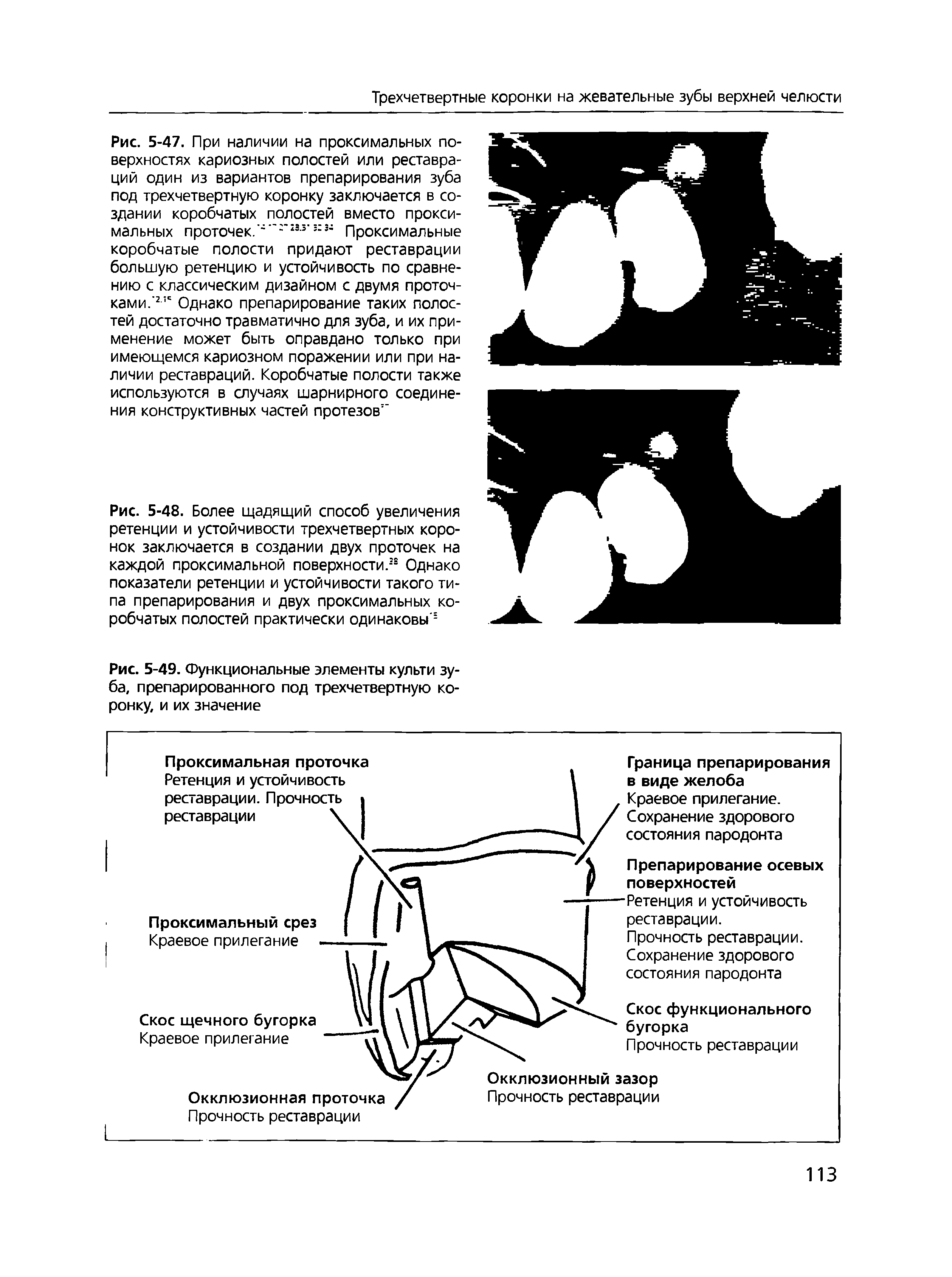 Рис. 5-49. Функциональные элементы культи зуба, препарированного под трехчетвертную коронку, и их значение...