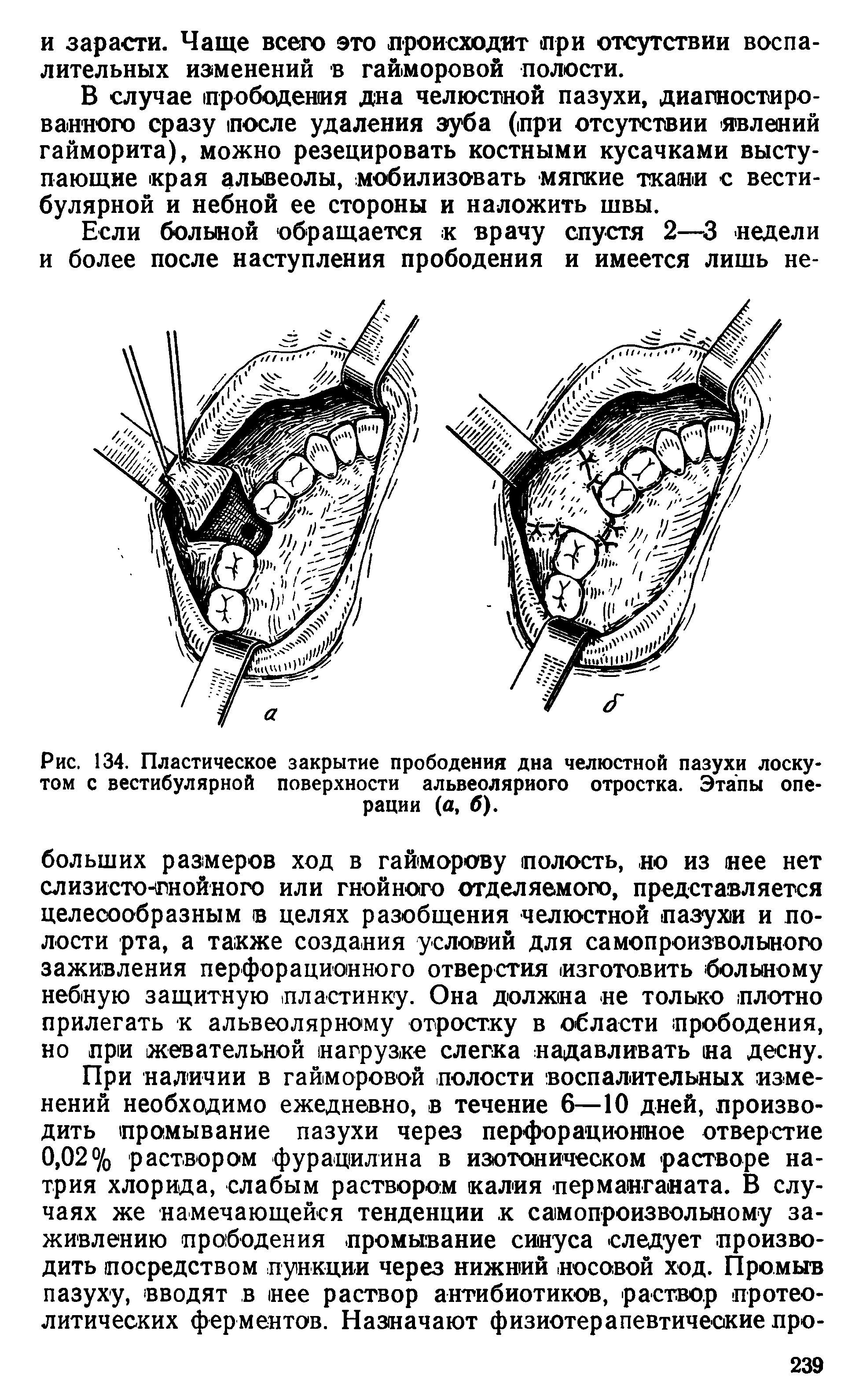 Рис. 134. Пластическое закрытие прободения дна челюстной пазухи лоскутом с вестибулярной поверхности альвеолярного отростка. Этапы операции (а, б).