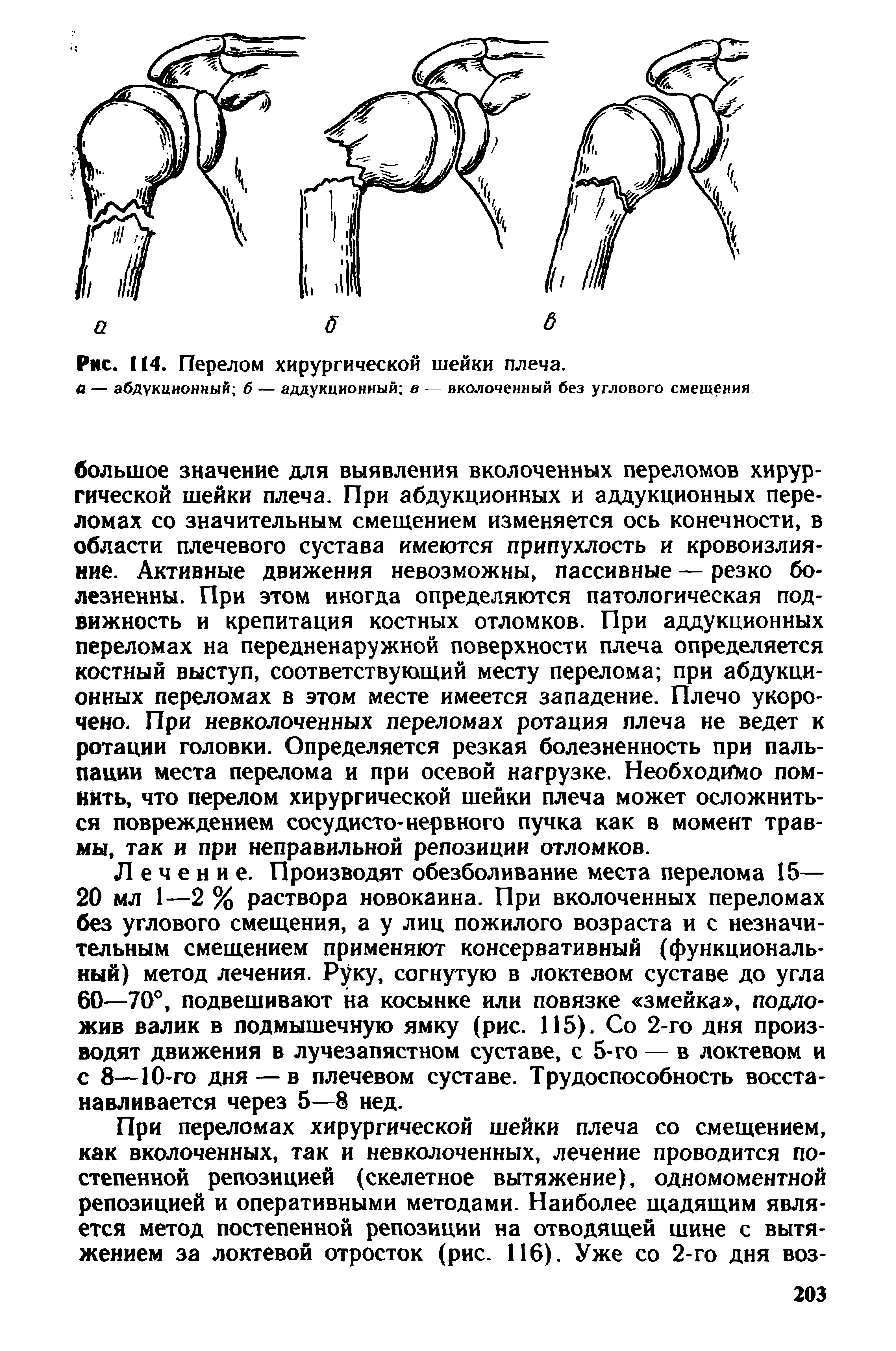 Перелом хирургической шейки плеча. Жалобы при переломе шейки плеча. Шейка плеча где находится перелом. Перелом шейки плеча со смещением лечение сроки восстановления.