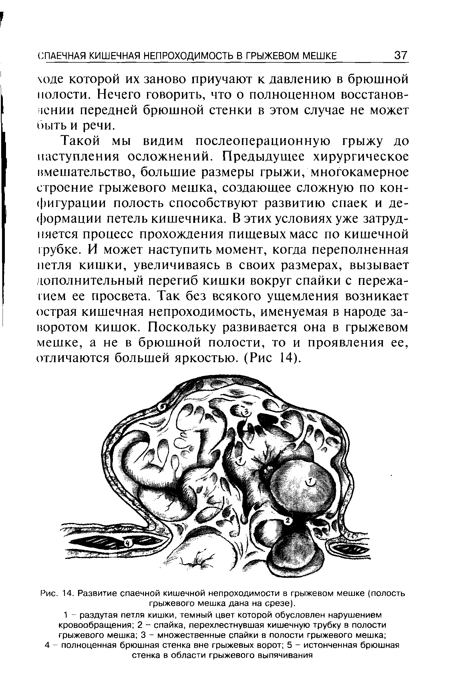 Рис. 14. Развитие спаечной кишечной непроходимости в грыжевом мешке (полость грыжевого мешка дана на срезе).