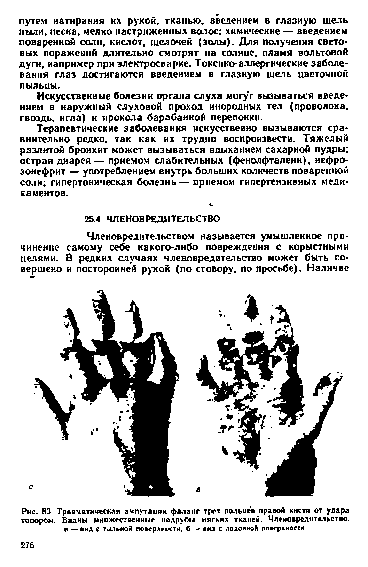 Рис. 83. Травматическая ампутация фаланг трех пальцев правой кисти от удара топором. Видны множественные надрубы мягких тканей. Членовредительство, в — вид с тильиой поверхности. 6 - вид с ладонной поверхности...