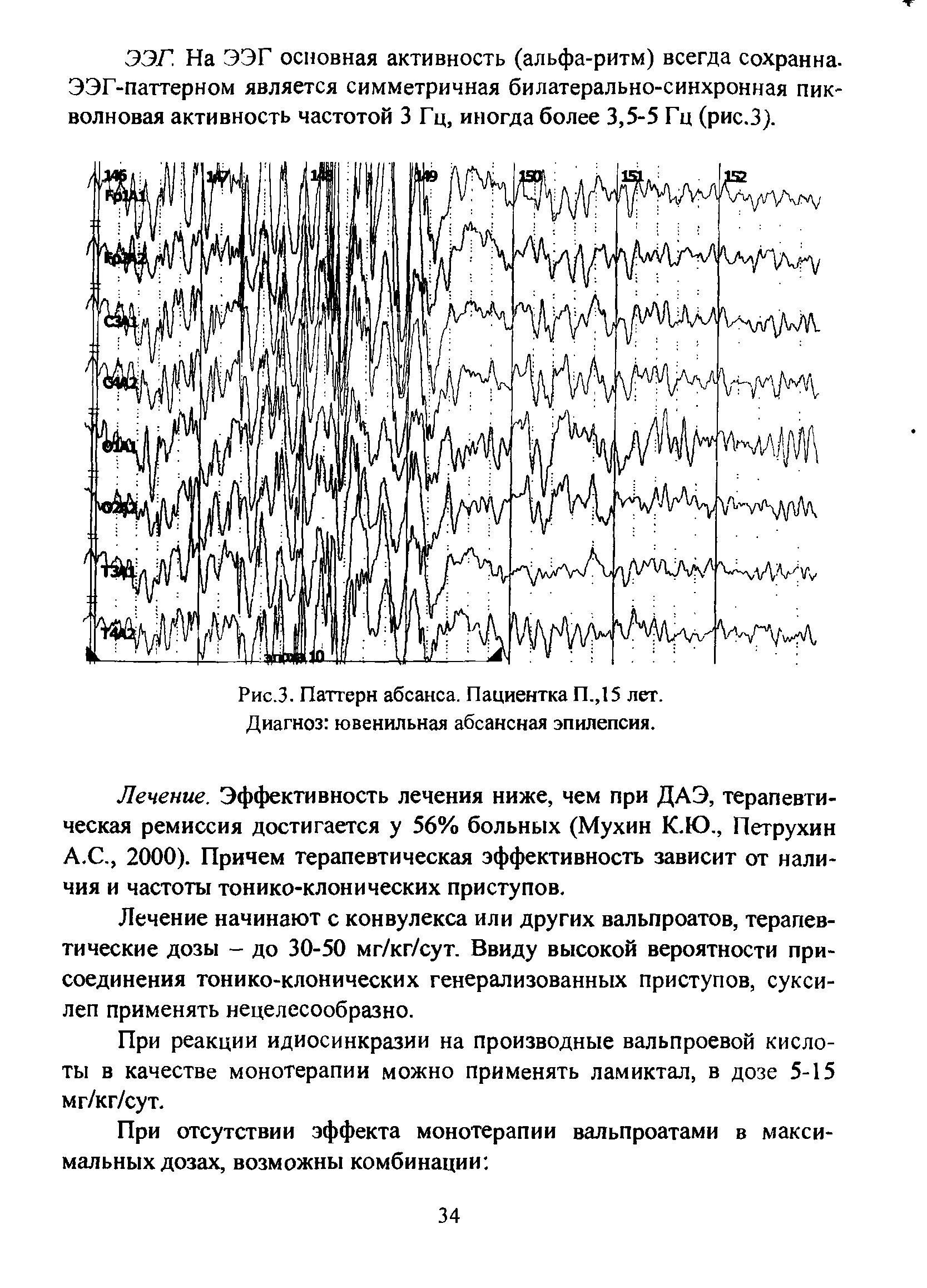 Рис.З. Паттерн абсанса. Пациентка П.,15 лет. Диагноз ювенильная абсансная эпилепсия.