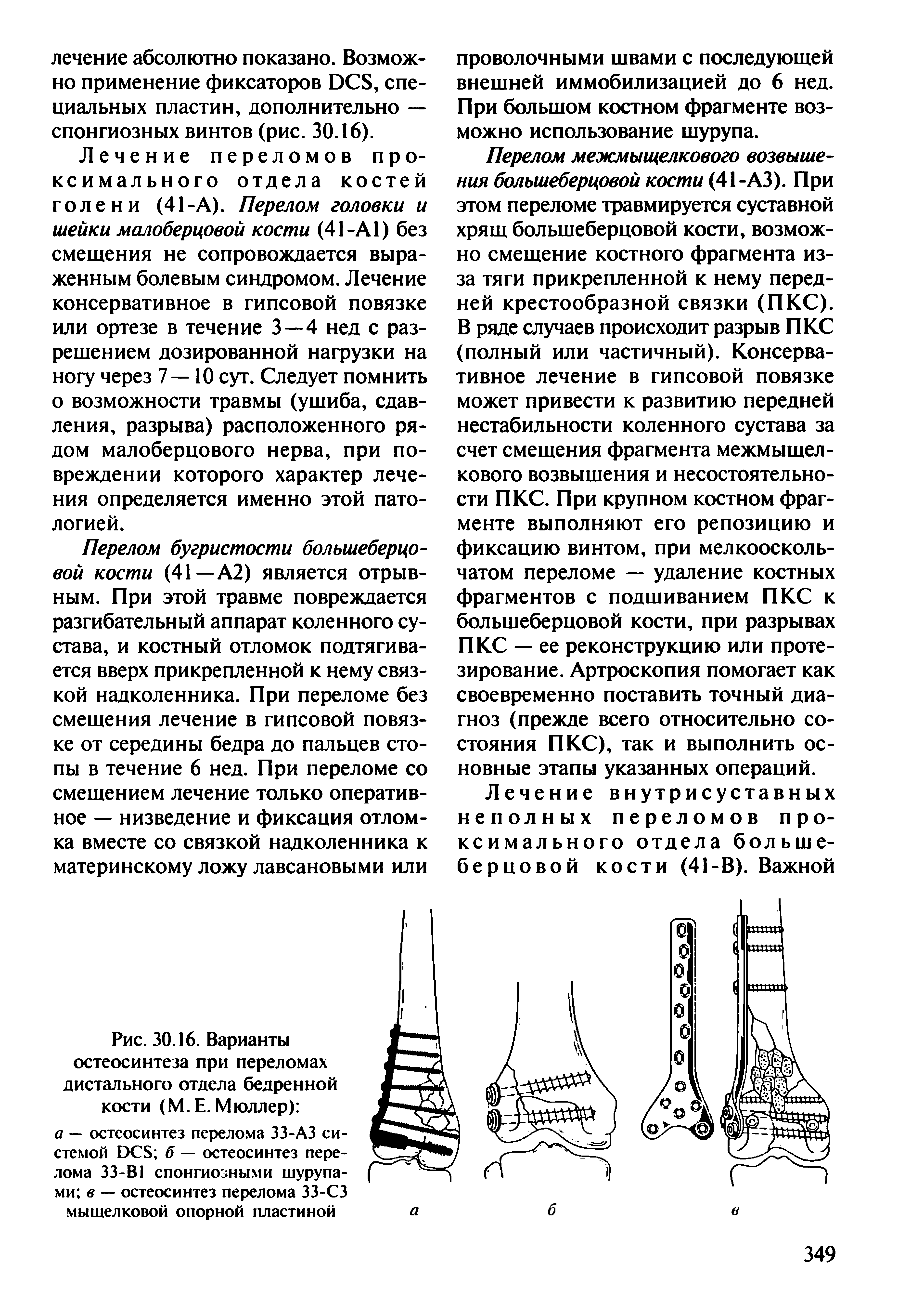 Рис. 30.16. Варианты остеосинтеза при переломах дистального отдела бедренной кости (М.Е. Мюллер) а — остеосинтез перелома ЗЗ-АЗ системой DCS б — остеосинтез перелома 33-BI спонгиозными шурупами в — остеосинтез перелома ЗЗ-СЗ мышелковой опорной пластиной...