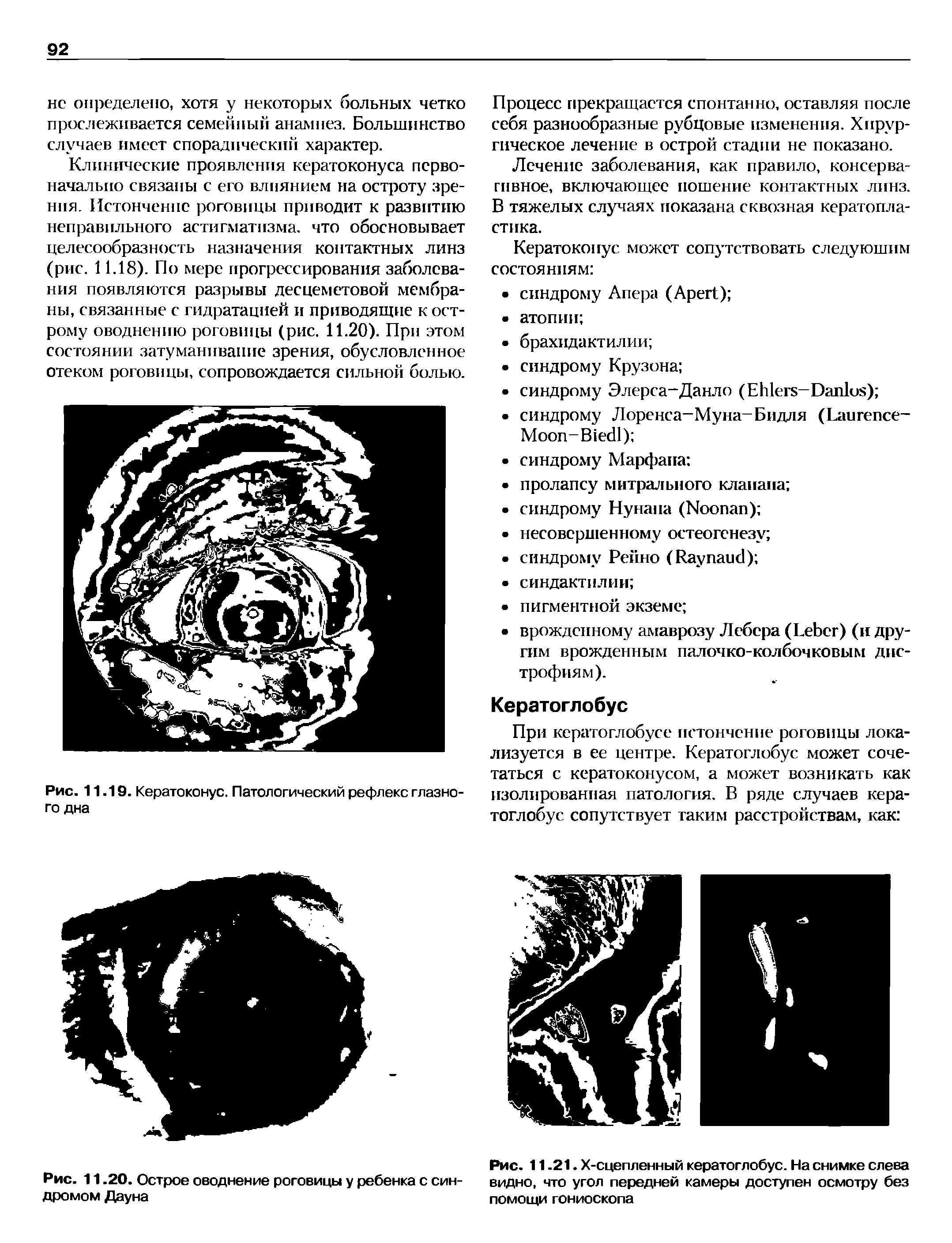 Рис. 11.21. Х-сцепленный кератоглобус. На снимке слева видно, что угол передней камеры доступен осмотру без помощи гониоскопа...