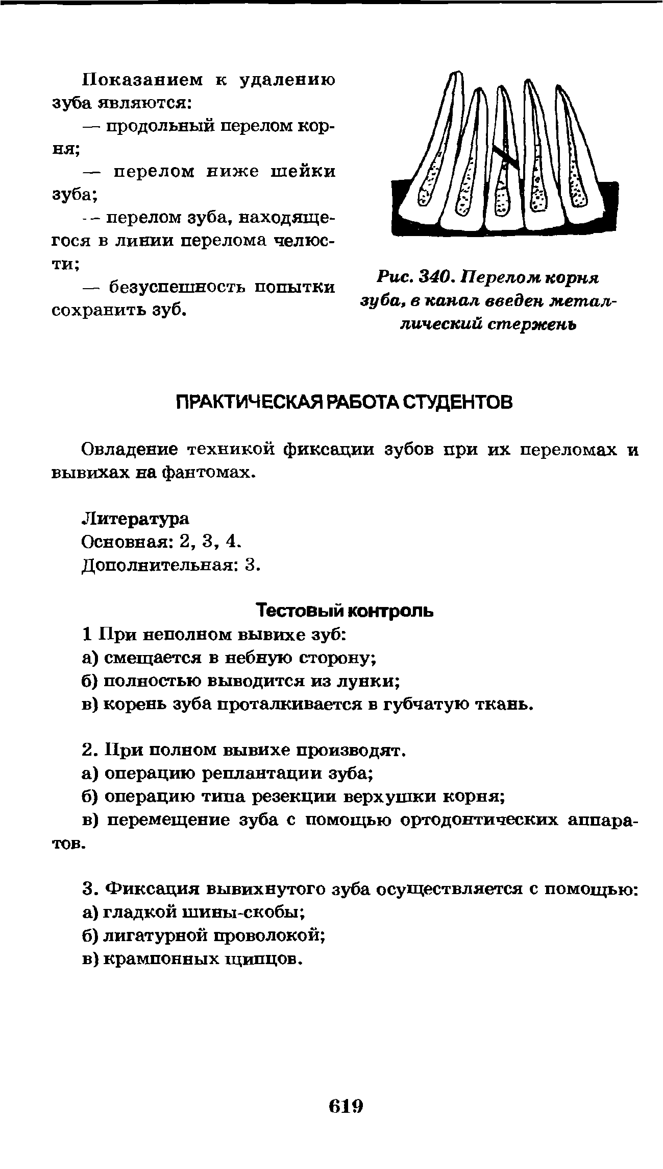 Рис. 340. Перелом корня зуба, в канал введен металлический стержень...