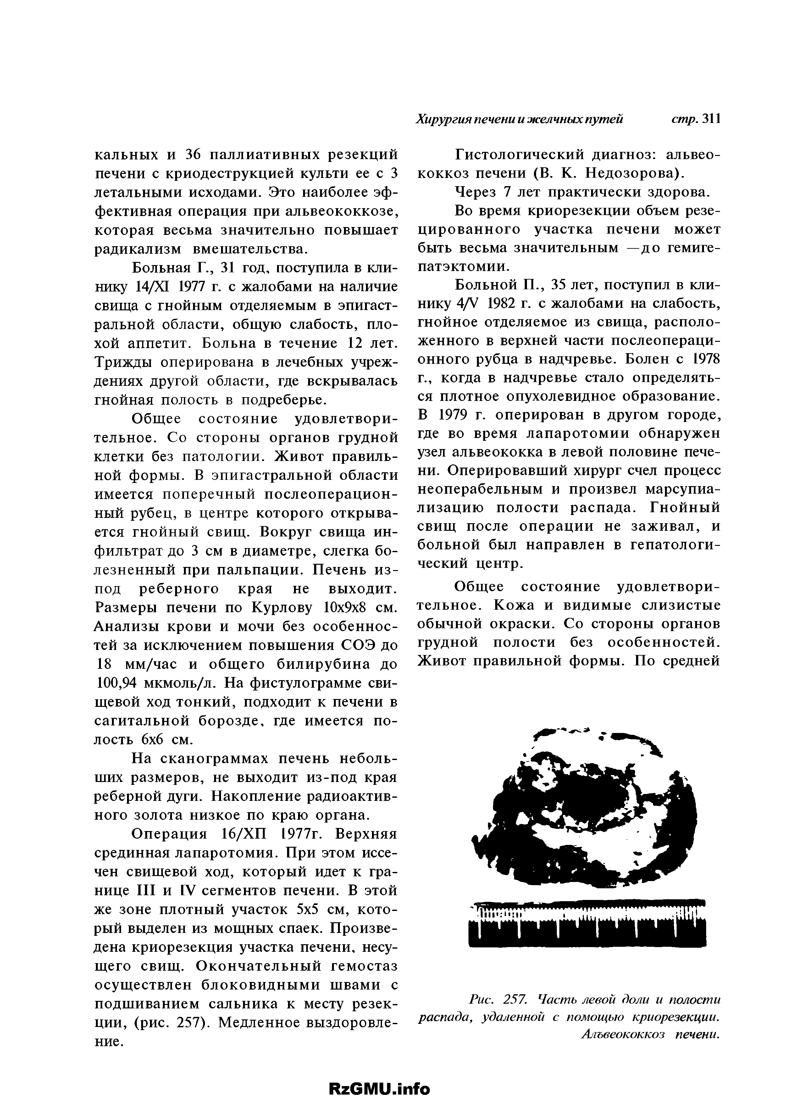 Рис. 257. Часть левой доли и полости распада, удаленной с помощью криорезекции. Альвеококкоз печени.