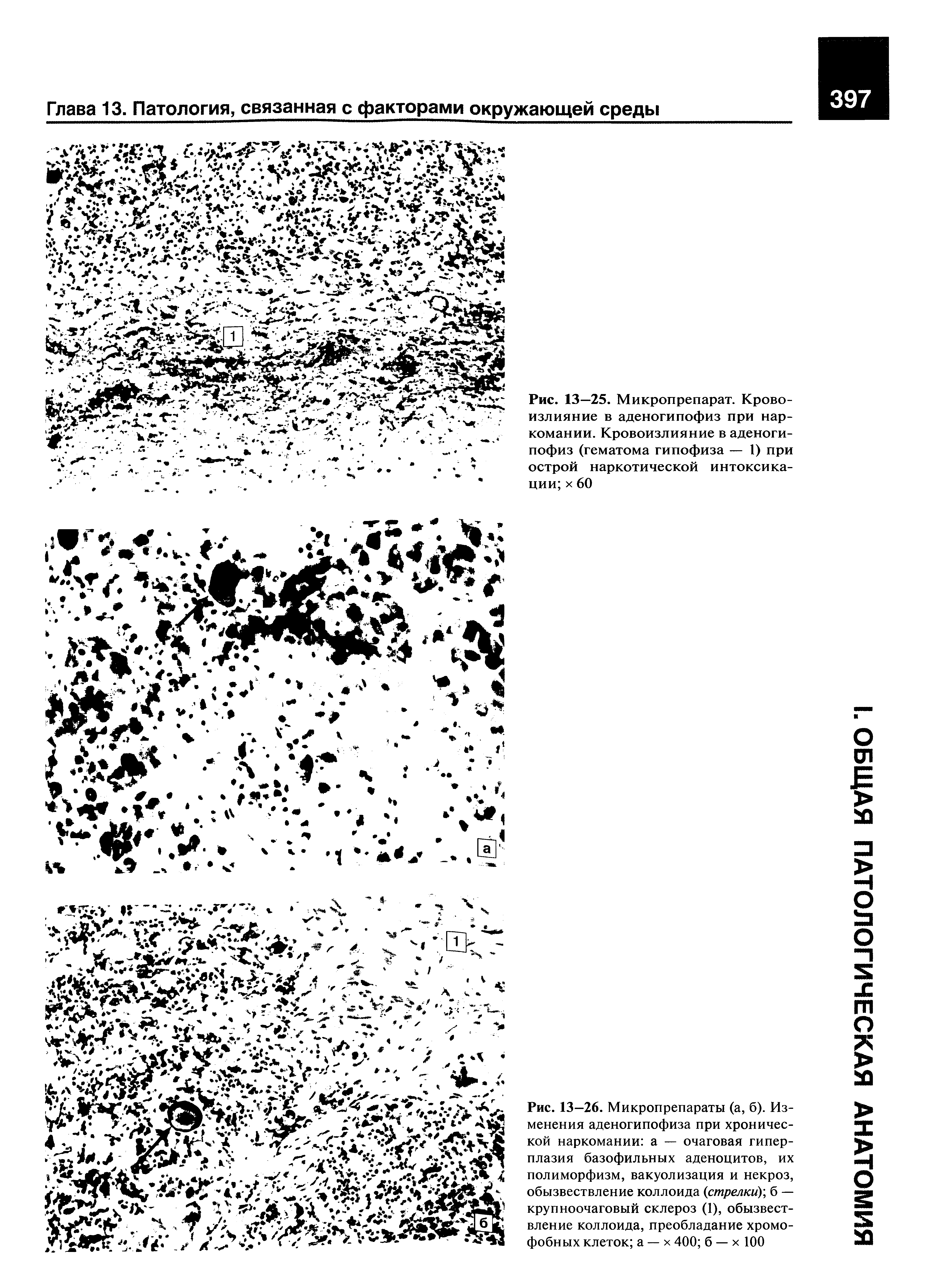 Рис. 13—26. Микропрепараты (а, б). Изменения аденогипофиза при хронической наркомании а — очаговая гиперплазия базофильных аденоцитов, их полиморфизм, вакуолизация и некроз, обызвествление коллоида (стрелки), б — крупноочаговый склероз (1), обызвествление коллоида, преобладание хромофобных клеток а — х 400 б — х 100...