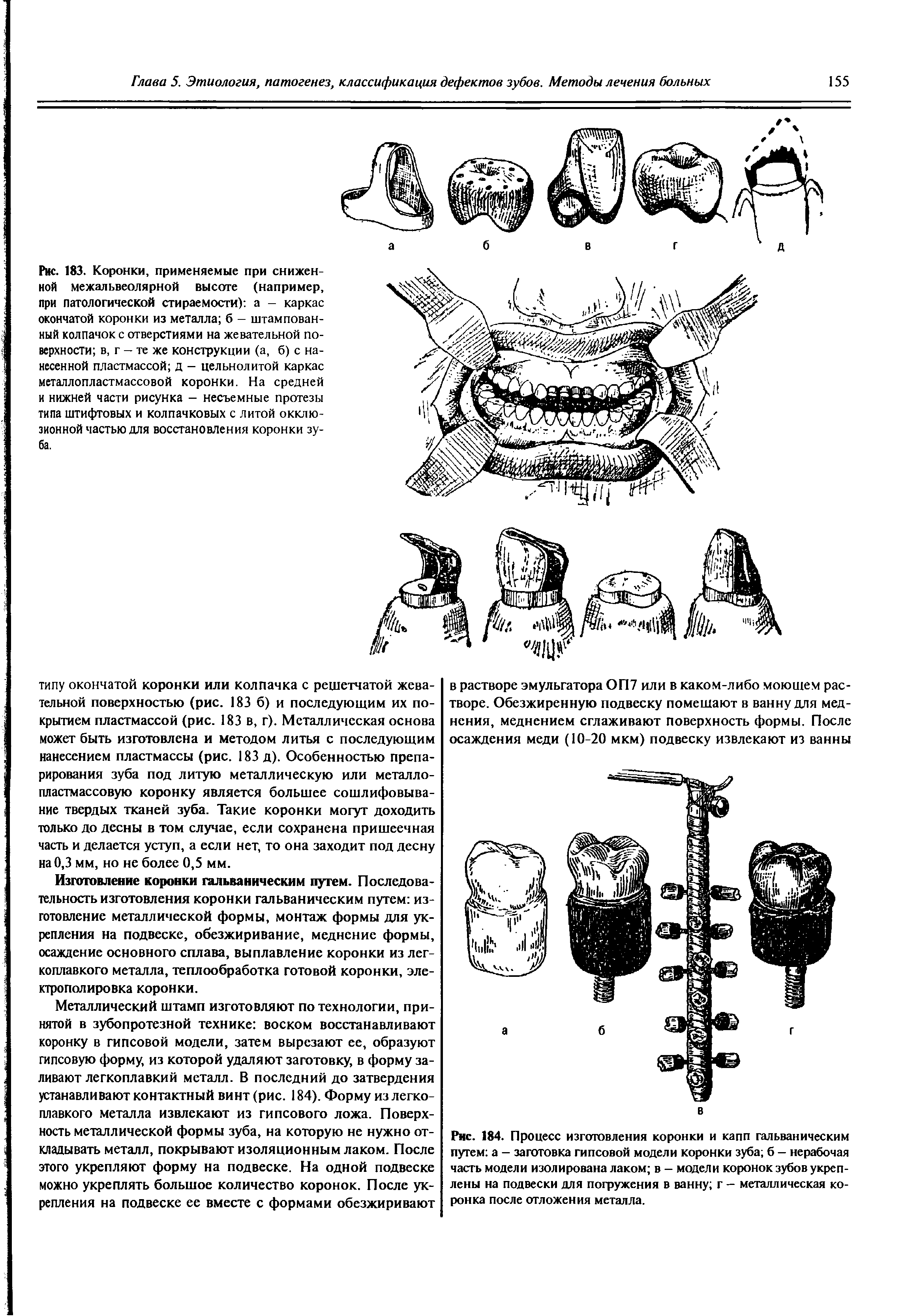 Рис. 184. Процесс изготовления коронки и капп гальваническим путем а — заготовка гипсовой модели коронки зуба б — нерабочая часть модели изолирована лаком в — модели коронок зубов укреплены на подвески для погружения в ванну г — металлическая коронка после отложения металла.