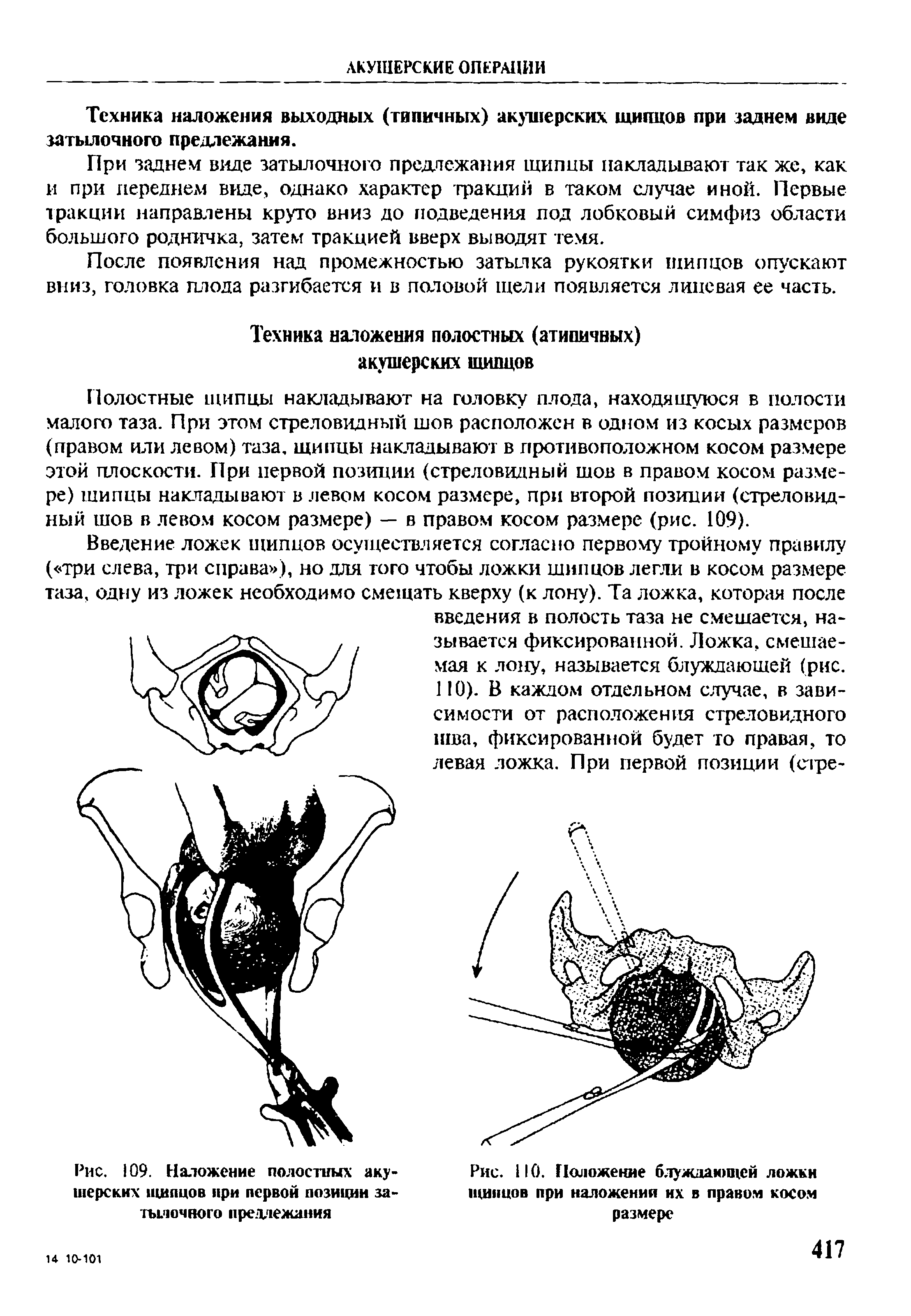 Рис. 109. Наложение полостных акушерских щипцов при первой позиции затылочного предлежания...