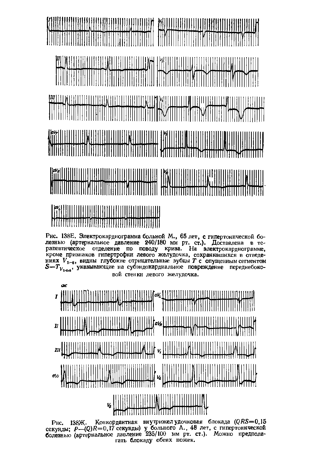 Рис. 138Ж- Конкордантная внутрижелудочковая блокада (рЯ5=0,15 секунды Р-—(0)8=0,17 секунды) у больного А., 48 лет, с гипертонической болезнью (артериальное давление 235/100 мм рт. ст.). Можно предполагать блокаду обеих ножек.