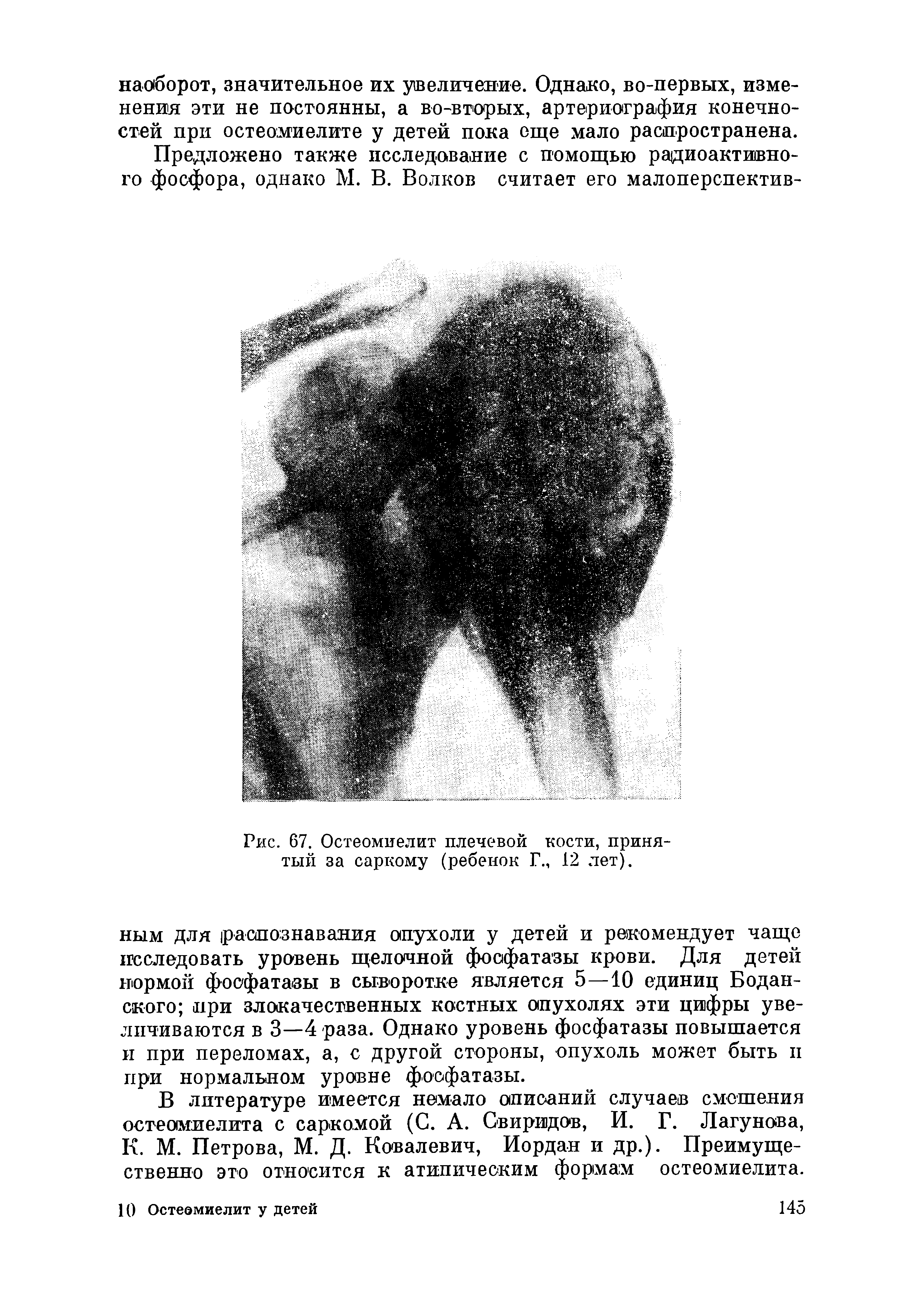 Рис. 67. Остеомиелит плечевой кости, принятый за саркому (ребенок Г., 12 лет).