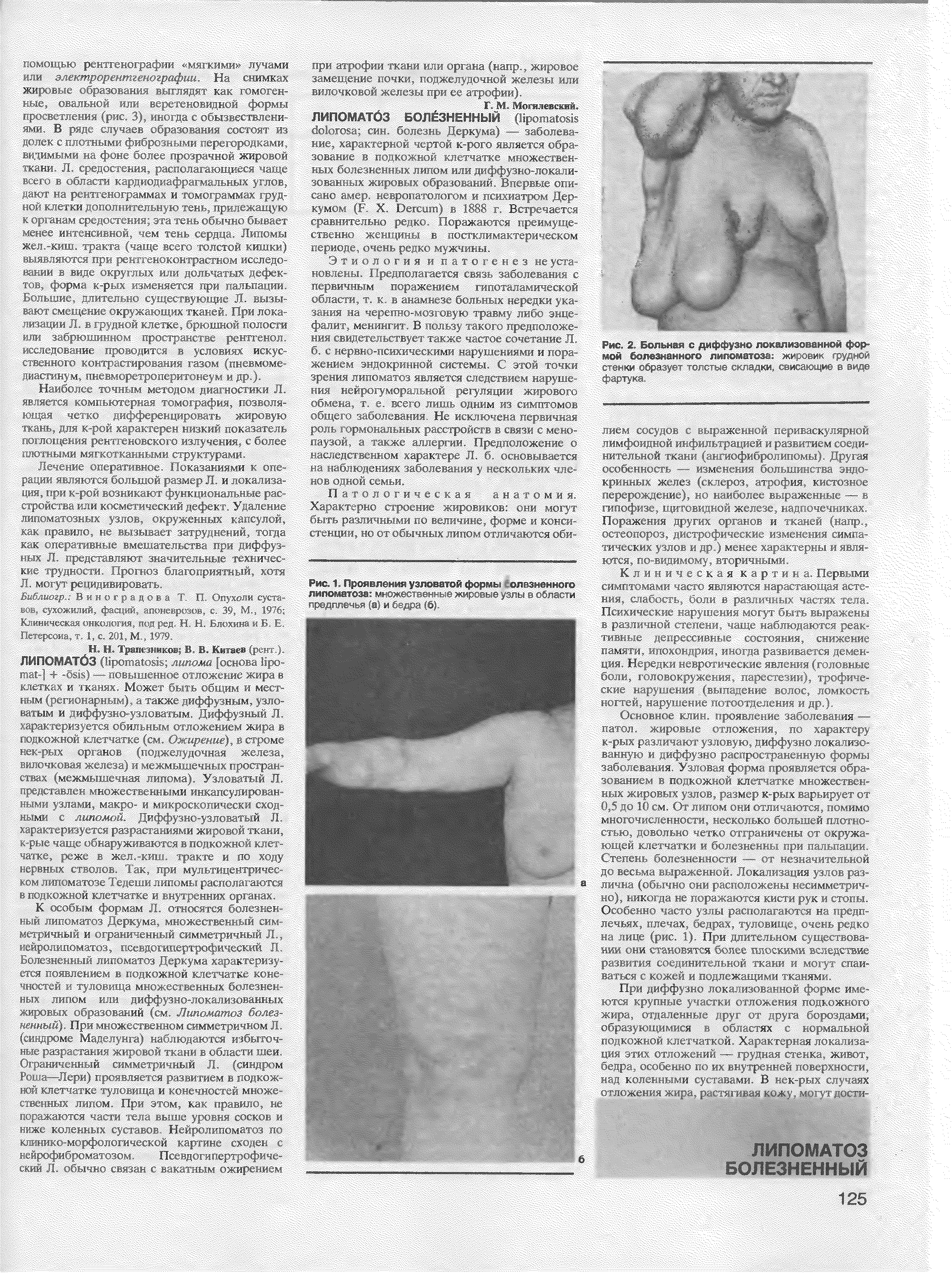 Рис. 1. Проявления узловатой формы б олезненного липоматоза мн да гдач-. ж-дада дан да(1да, ги-чрррпо -к.й га и. .дара < )...