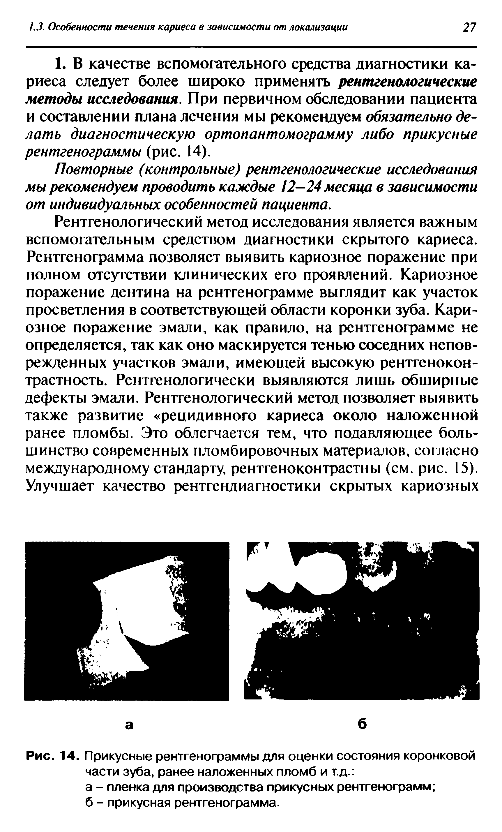 Рис. 14. Прикусные рентгенограммы для оценки состояния коронковой части зуба, ранее наложенных пломб и т.д. ...