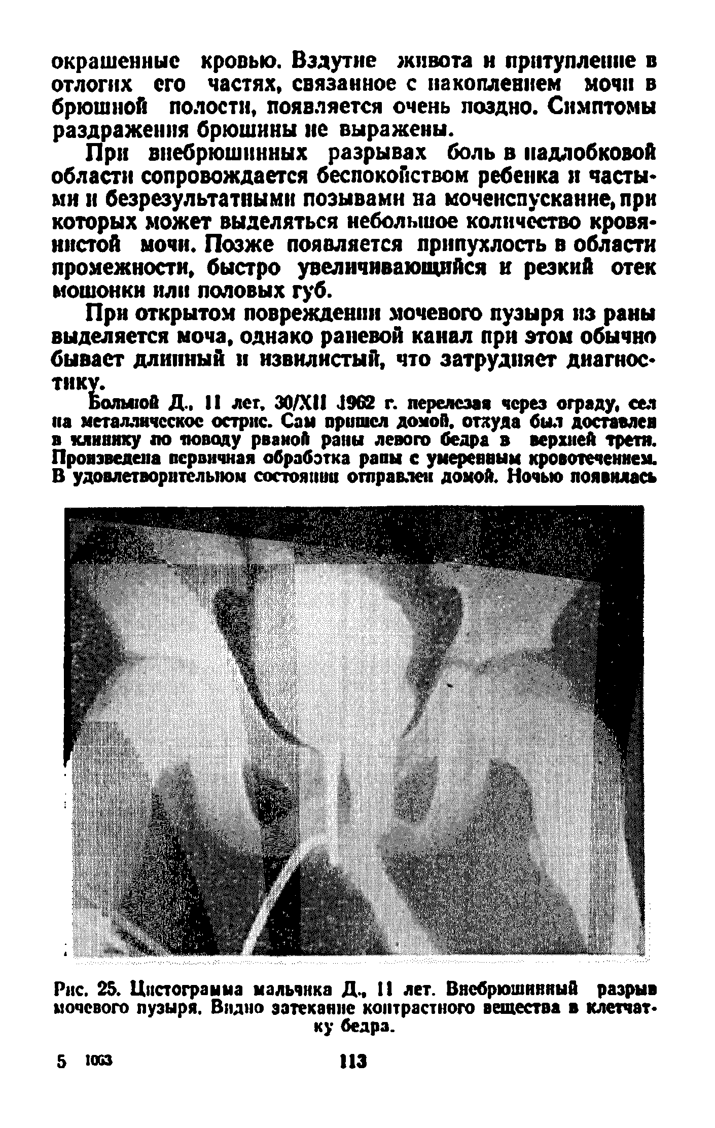 Рис. 25. Цистограмма мальчика Д., 11 лет. Внебрюшннпый разрыв мочевого пузыря. Видно затекание контрастного вещества в клетчатку бедра.