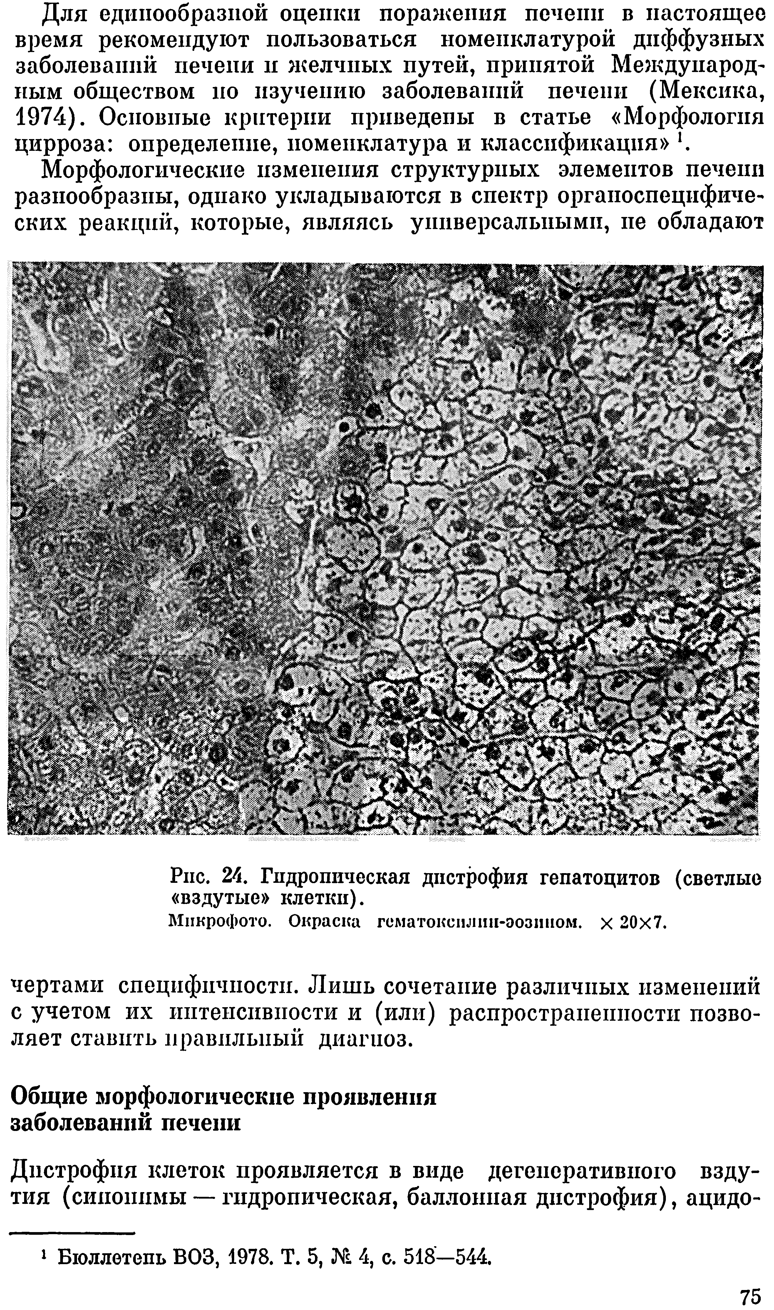 Рис. 24. Гидропическая дистрофия гепатоцитов (светлые вздутые клетки).