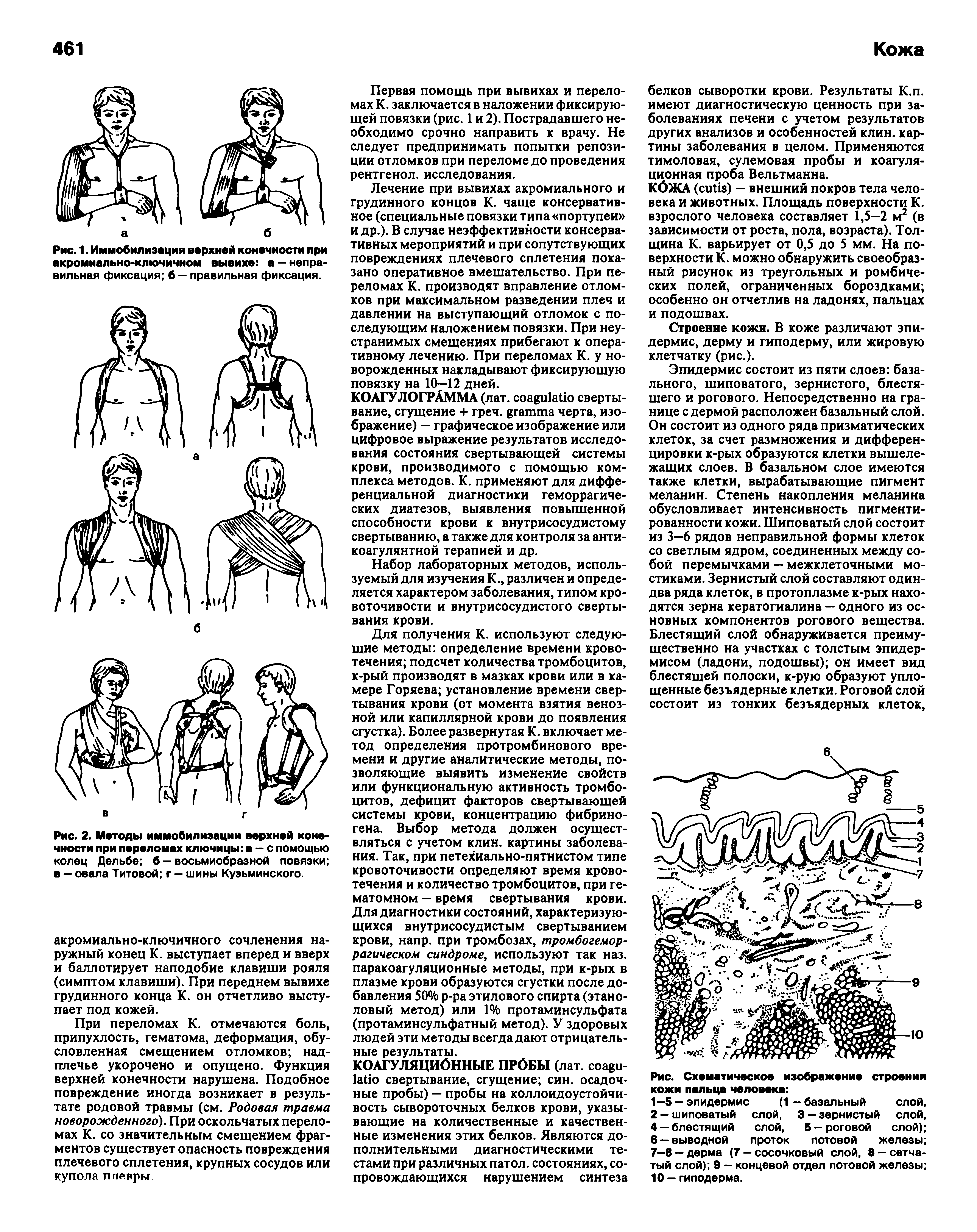 Рис. 2. Методы иммобилизации верхней конечности при переломах ключицы а — с помощью колец Дельбе б - восьмиобразной повязки в — овала Титовой г — шины Кузьминского.