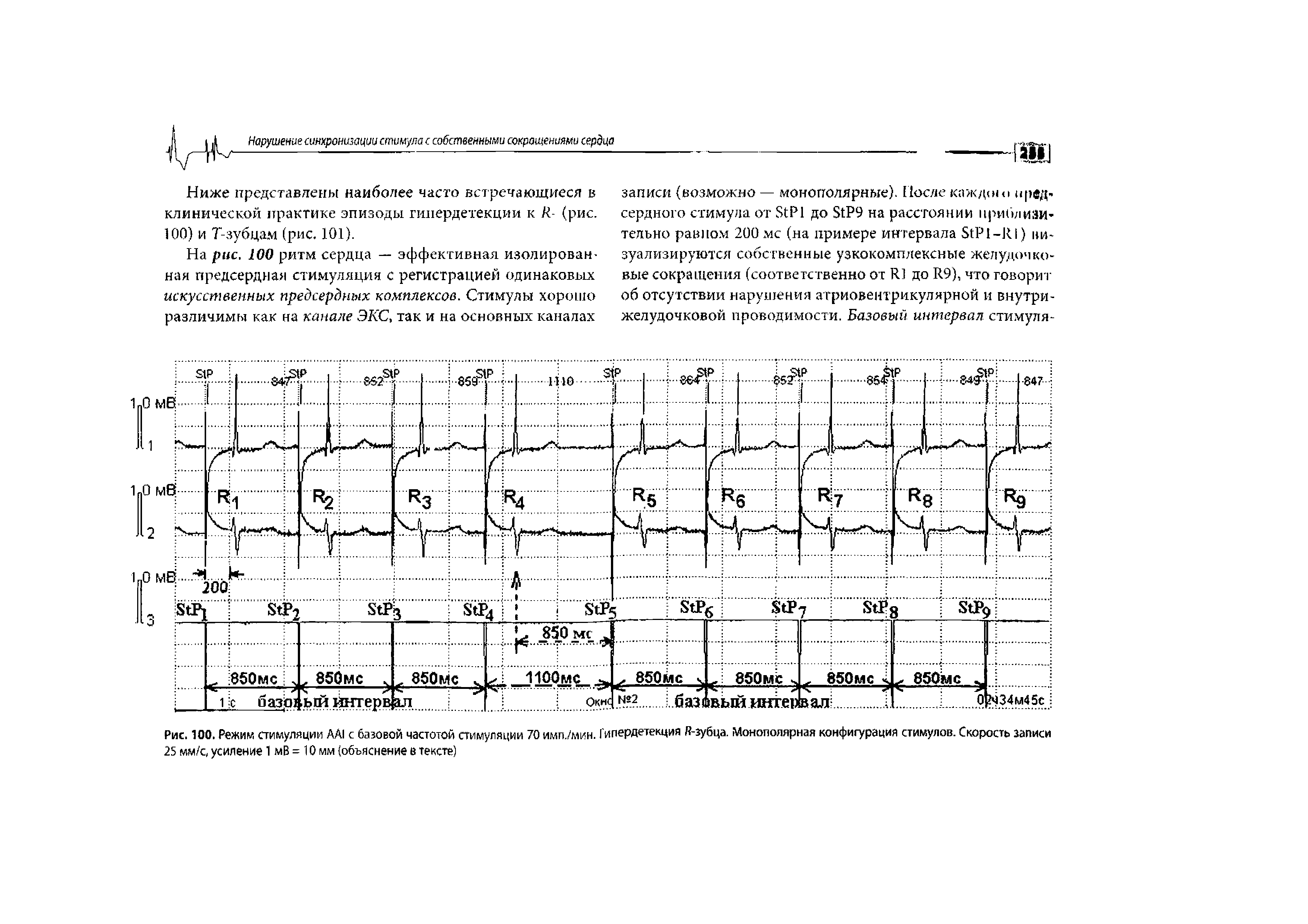 Рис. 100. Режим стимуляции AAI с базовой частотой стимуляции 70 имп./мин. Гипердетекция R-зубца. Монополярная конфигурация стимулов. Скорость записи 25 мм/с, усиление 1 мВ = 10 мм (объяснение в тексте)...