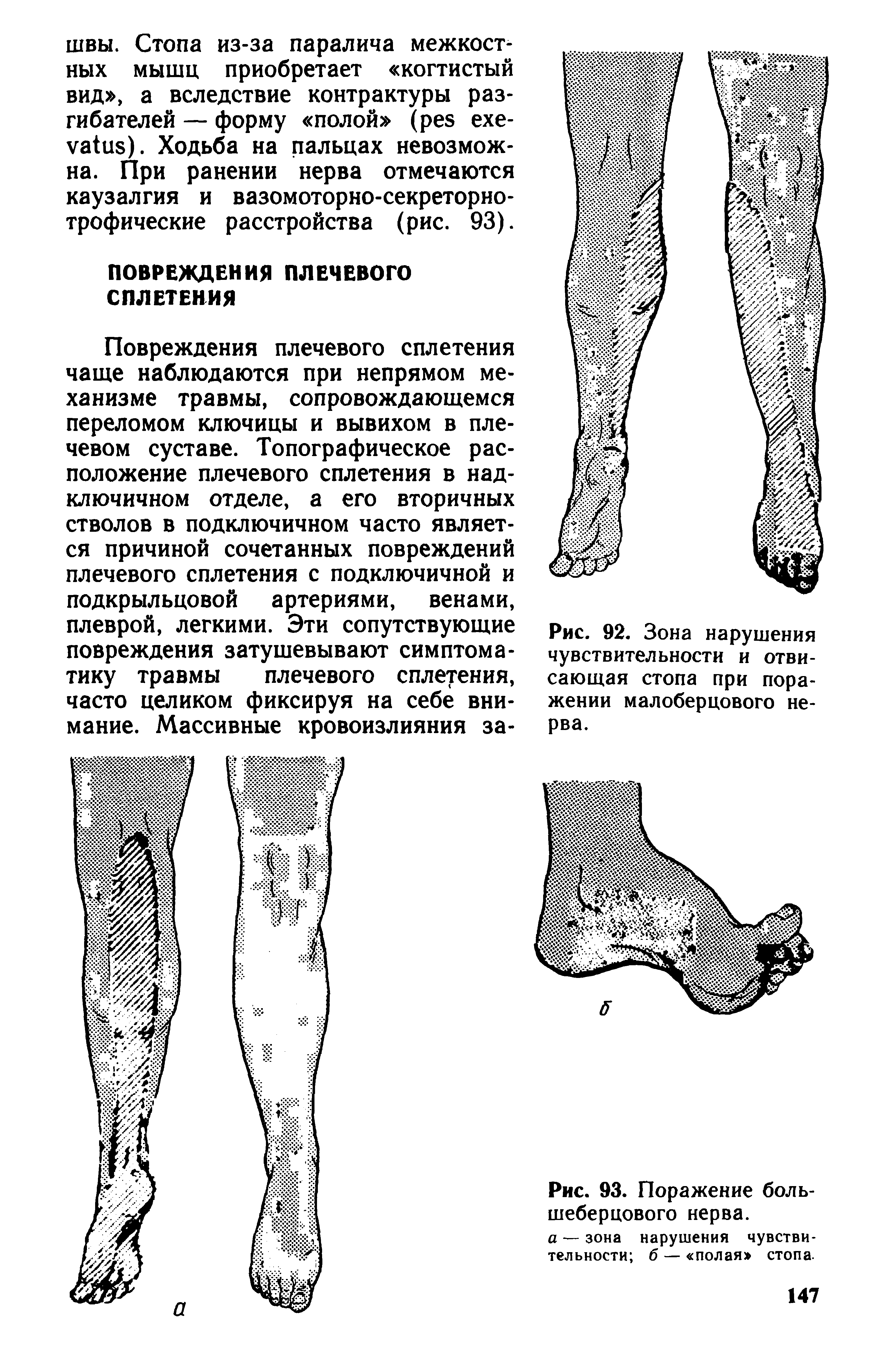 Рис. 92. Зона нарушения чувствительности и отвисающая стопа при поражении малоберцового не-...