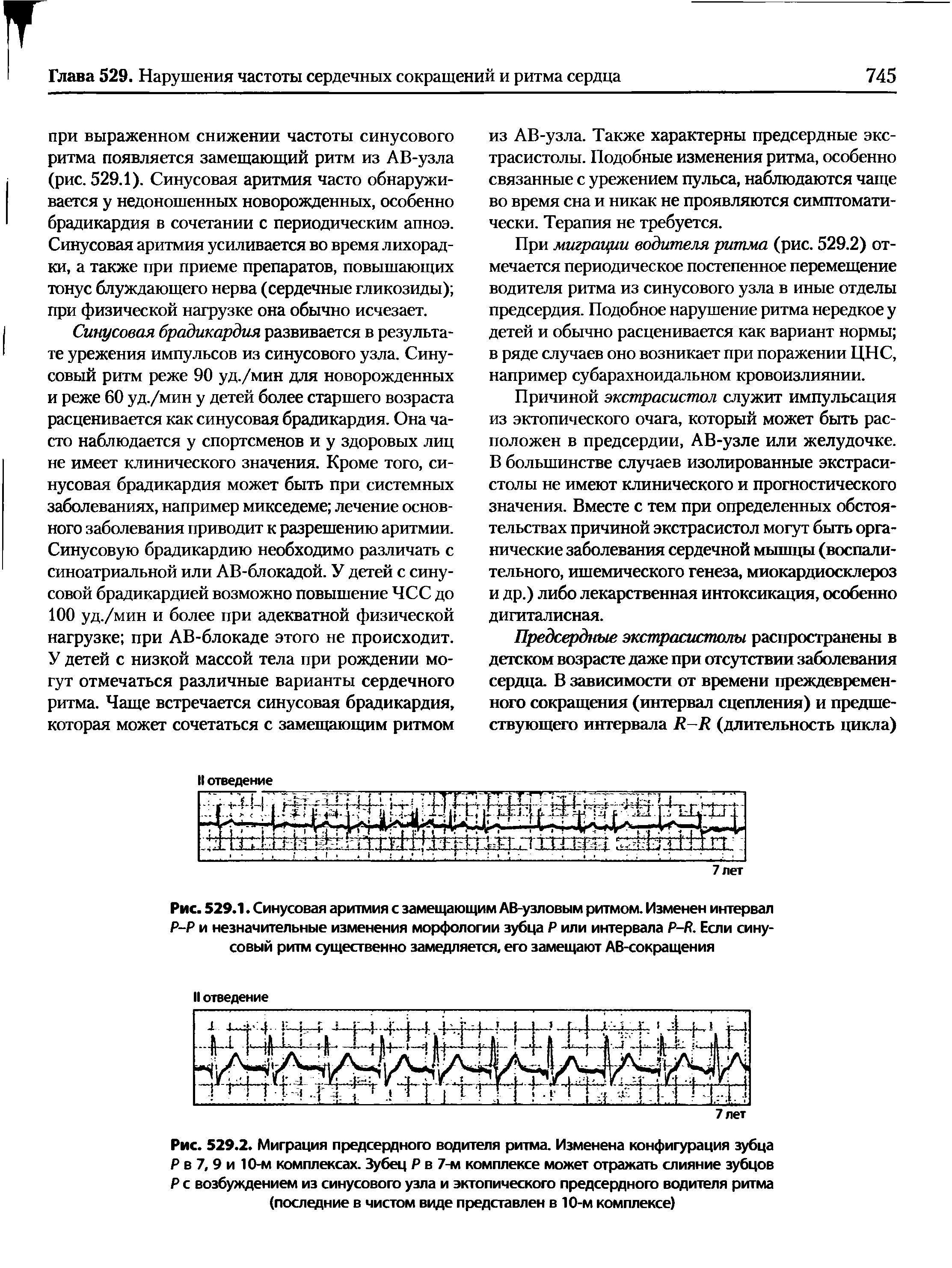 Рис. 529.1. Синусовая аритмия с замещающим АВ-узловым ритмом. Изменен интервал Р-Р и незначительные изменения морфологии зубца Р или интервала Р-Р. Если синусовый ритм существенно замедляется, его замещают АВ-сокращения...