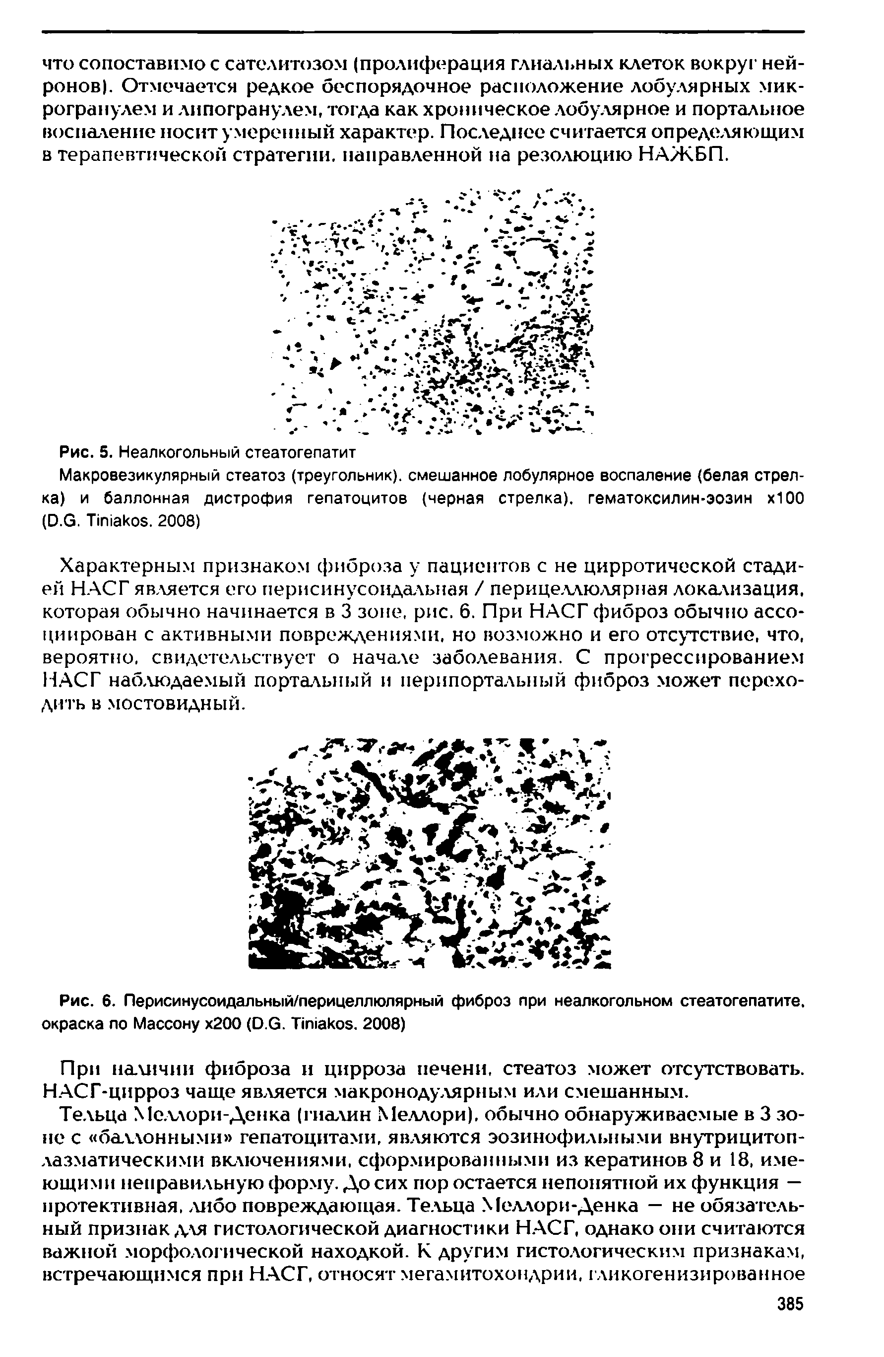 Рис. 6. Перисинусоидапьный/перицеллюлярный фиброз при неалкогольном стеатогепатите, окраска по Массону х200 (Р.С. Т П1акоз. 2008)...