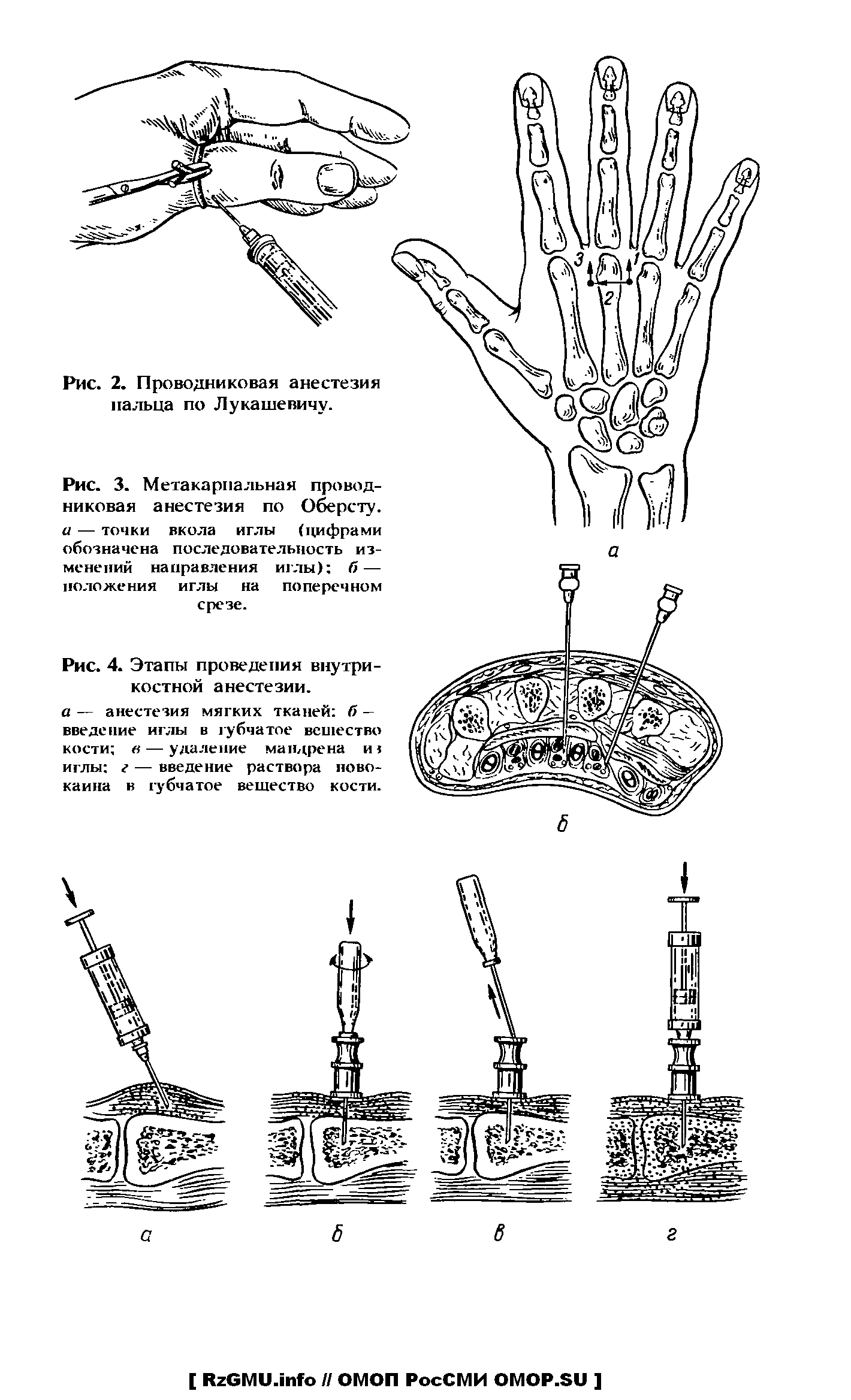 Рис. 3. Метакарпальная проводниковая анестезия по Оберсту. а — точки вкола иглы (цифрами обозначена последовательность изменений направления иглы) б— положения иглы на поперечном срезе.