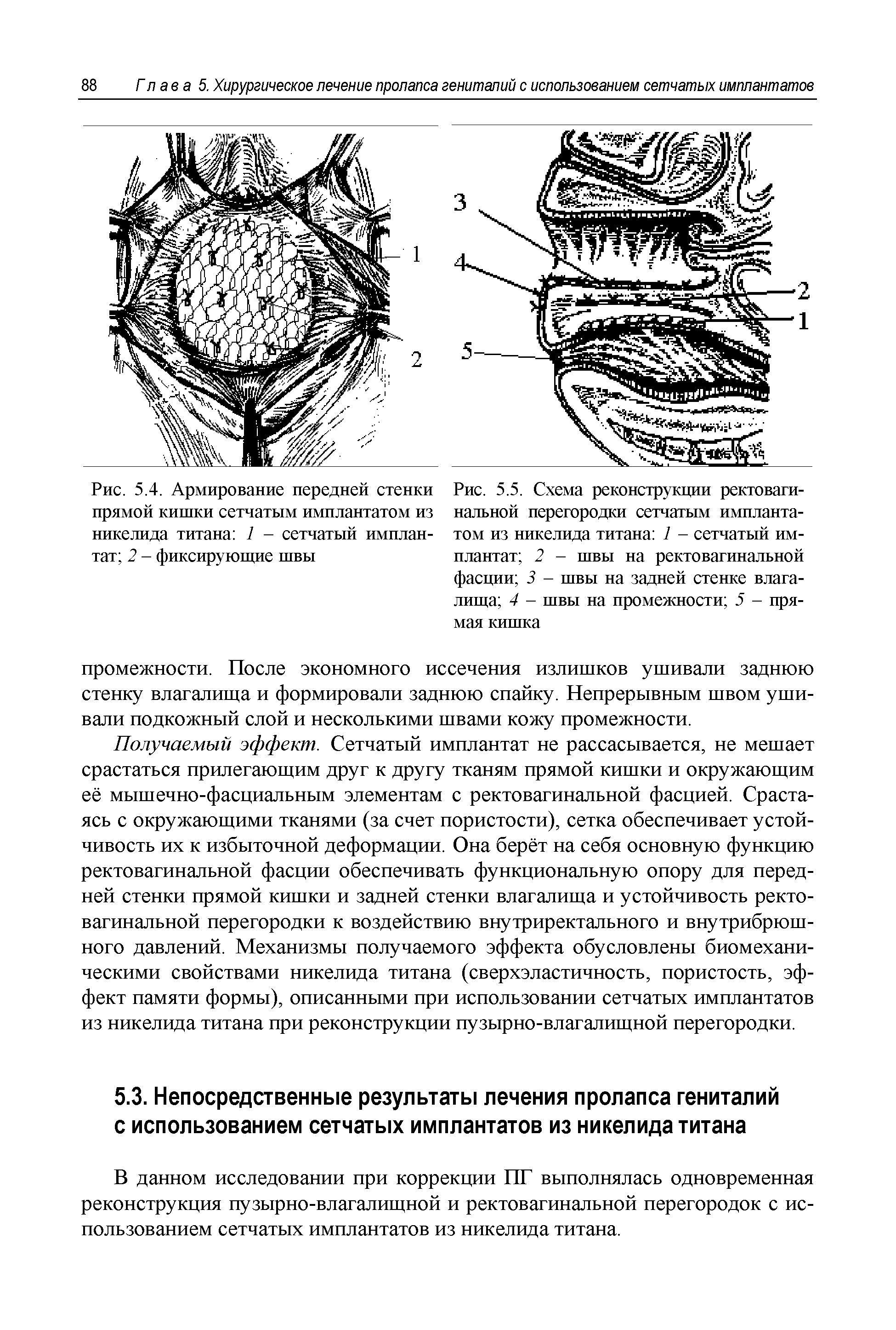Рис. 5.5. Схема реконструкции ректовагинальной перегородки сетчатым имплантатом из никелида титана 1 - сетчатый имплантат 2 - швы на ректовагинальной фасции 3 - швы на задней стенке влагалища 4 - швы на промежности 5 - прямая кишка...
