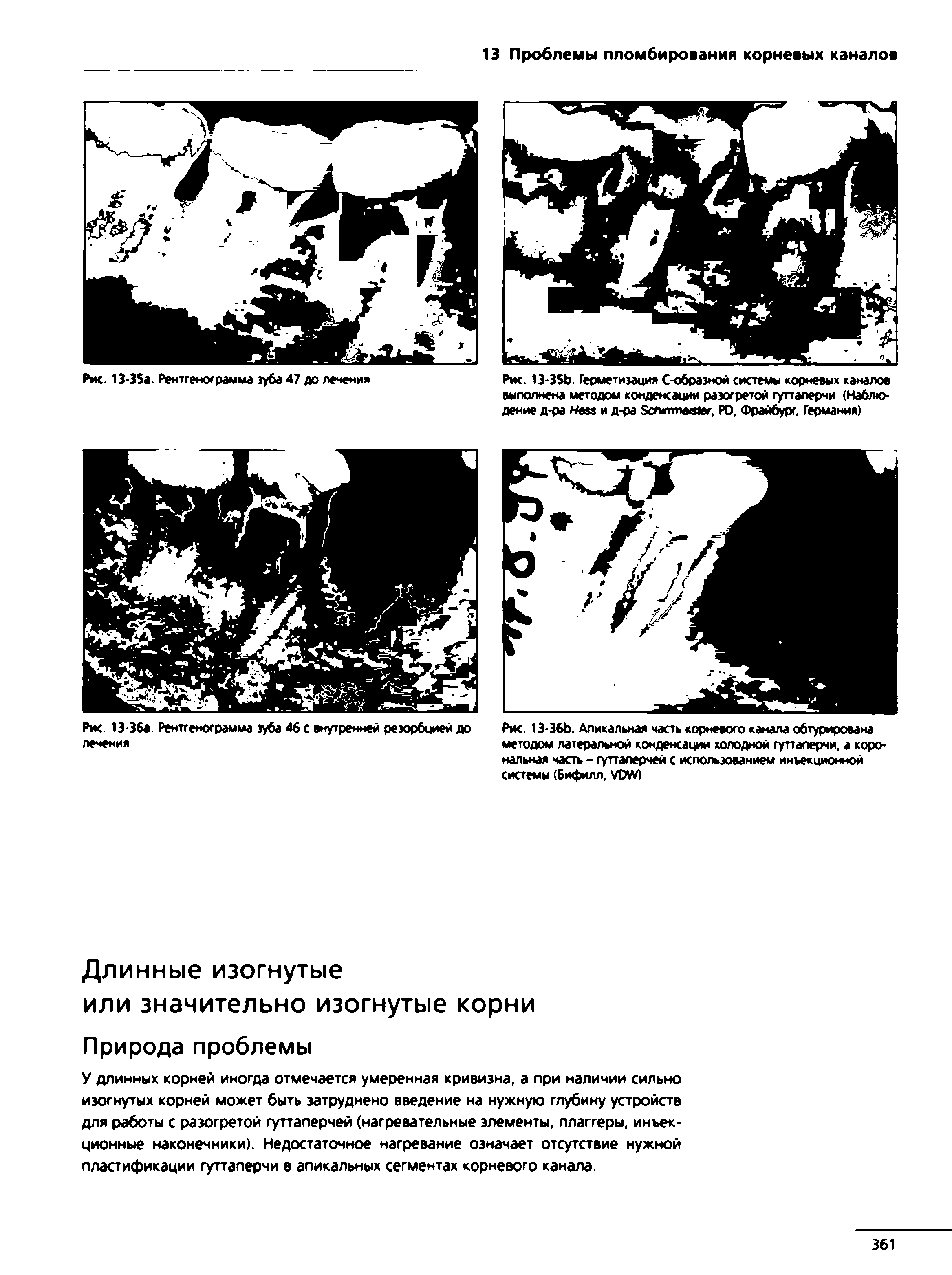 Рис. 13-35Ь. Герметизация С-образной системы корневых каналов выполнена методом конденсации разогретой гуттаперчи (Наблюдение д-ра Нвзз и д-ра ЗсГмггтв ег, РО, Фрайбург, Германия)...