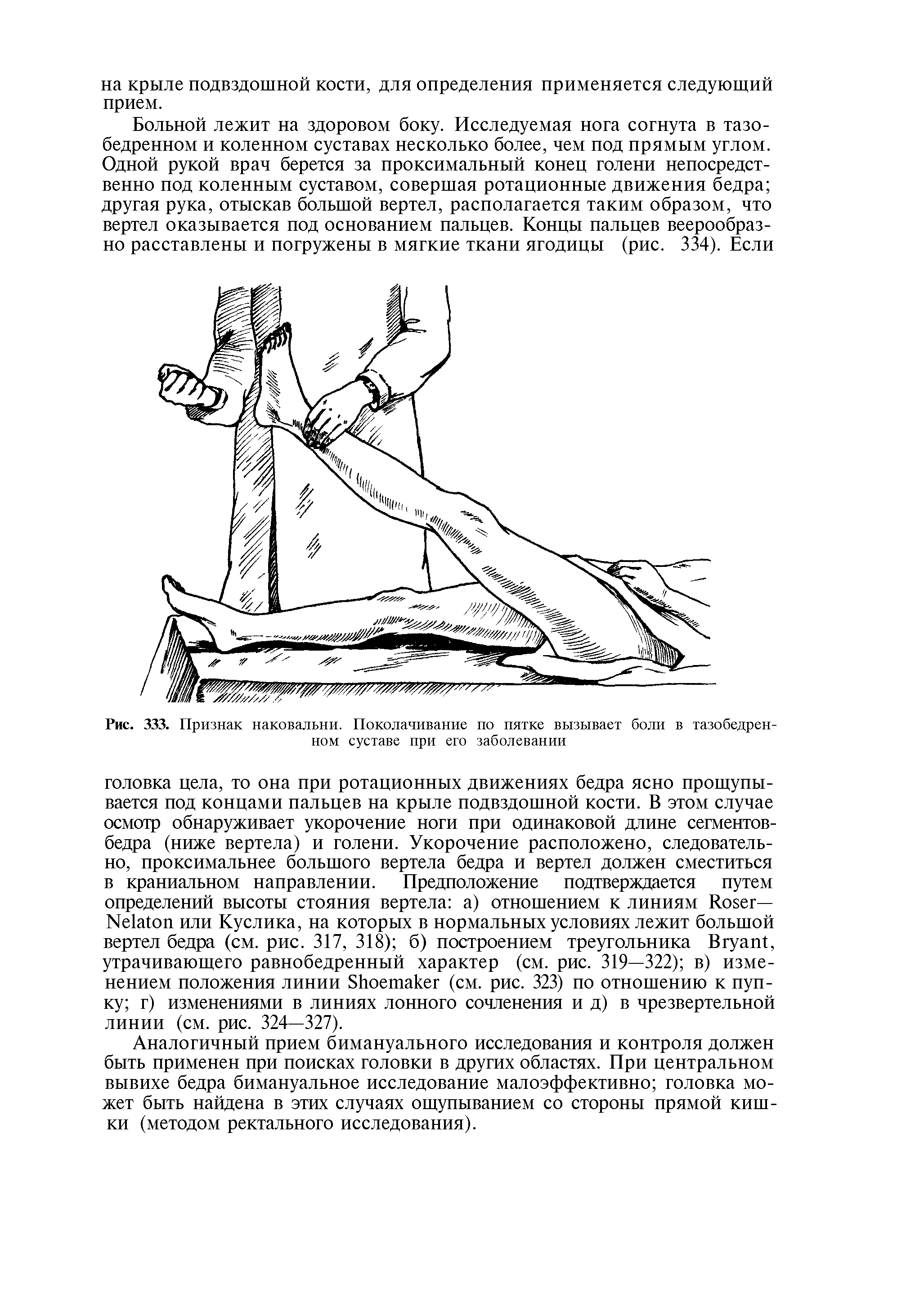 Рис. 333. Признак наковальни. Поколачивание по пятке вызывает боли в тазобедренном суставе при его заболевании...