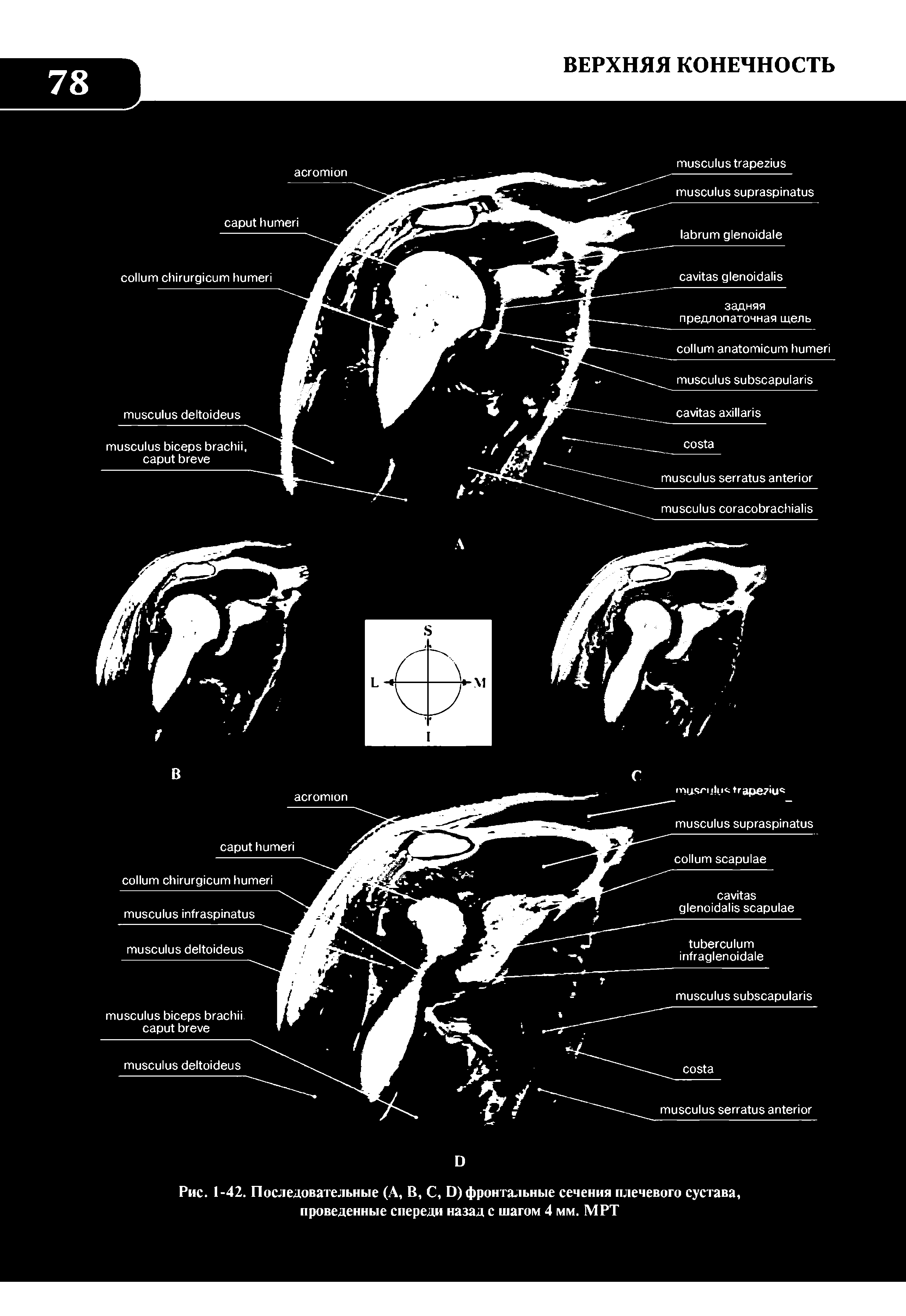 Рис. 1-42. Последовательные (А, В, С, О) фронтальные сечения плечевого сустава, проведенные спереди назад с шагом 4 мм. МРТ...