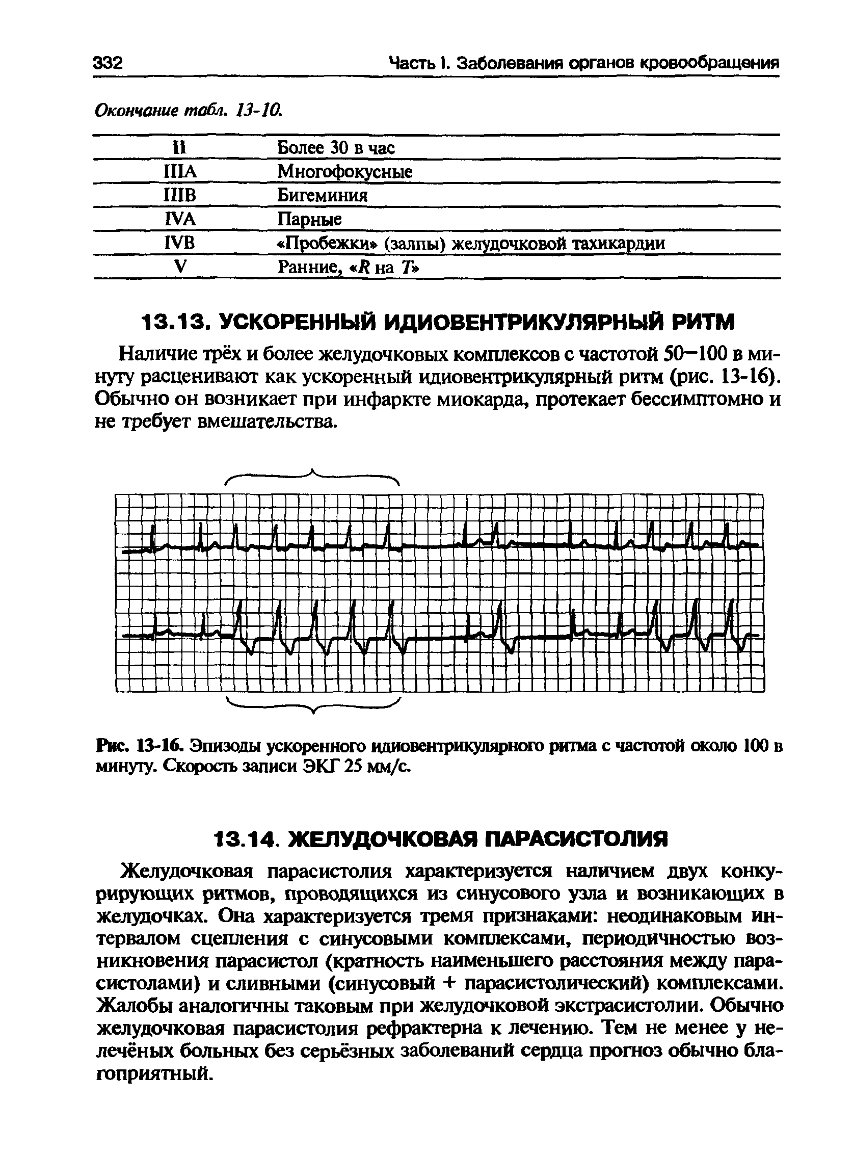 Рис. 13-16. Эпизоды ускоренного идиовентрикулярного ритма с частотой около 100 в минуту. Скорость записи ЭКГ 25 мм/с.