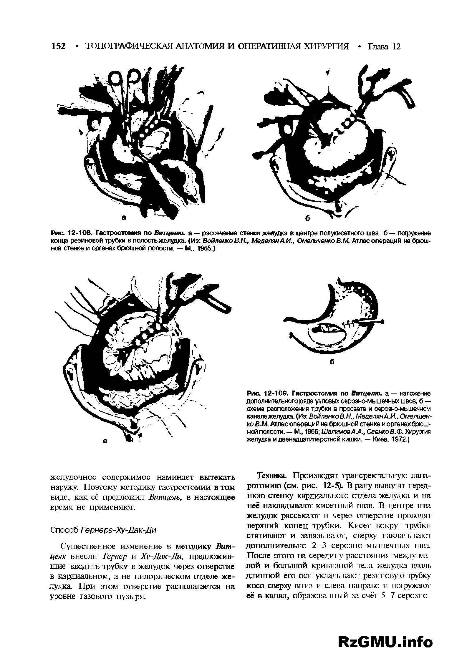 Рис. 12-108. Гастростомия по Витцелю. а — рассечемте стенки желудка в центре полукисетного шва б — погружение конца резиновой трубки в полость желудка. (Из Войлежо В.Н., МеделянА.И., Омельченко В.М. Атлас операций набрюшной стенке и органах брюшной полости. — М.. 1965.)...