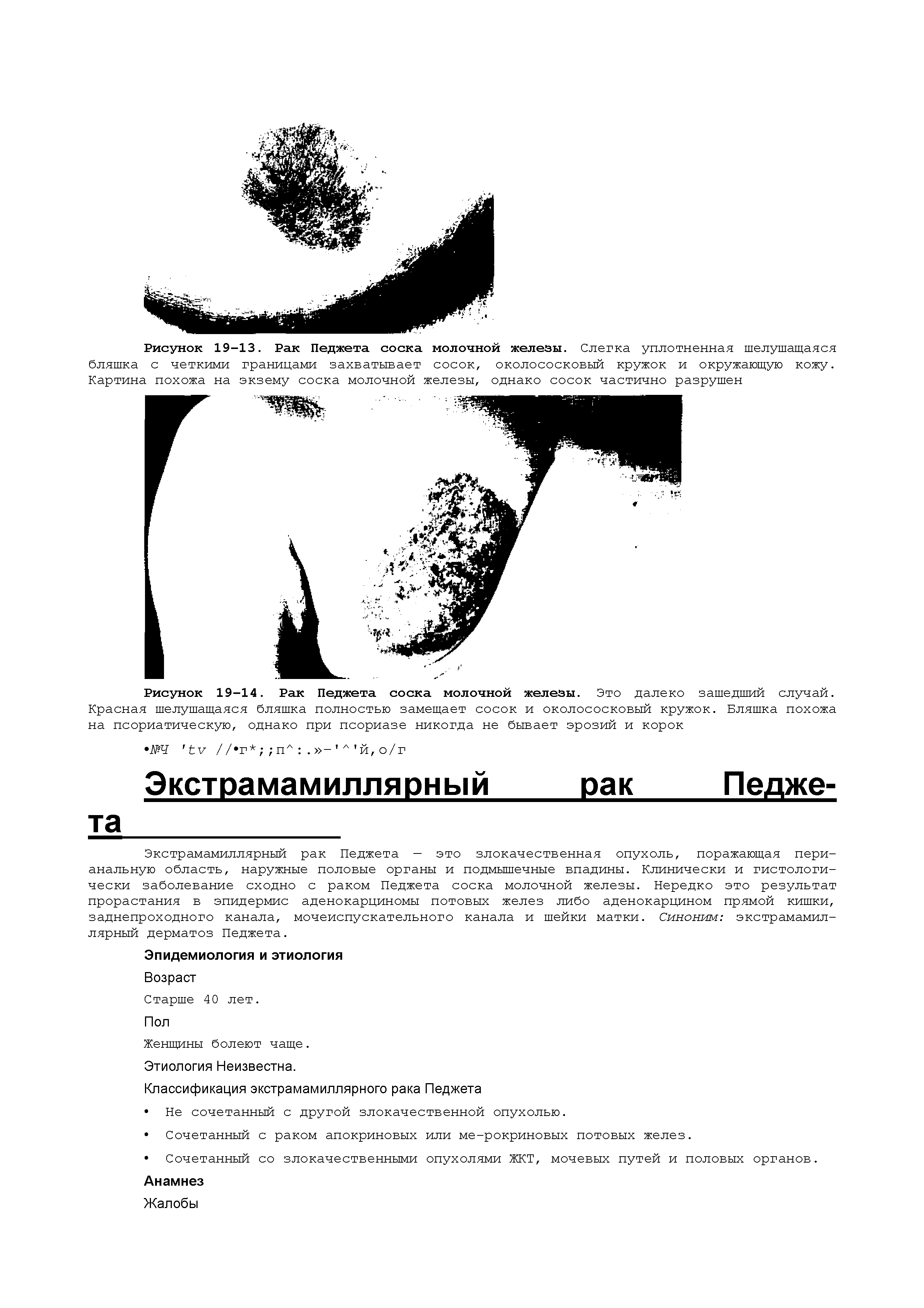 Рисунок 19-14. Рак Педжета соска молочной железы. Это далеко зашедший случай.