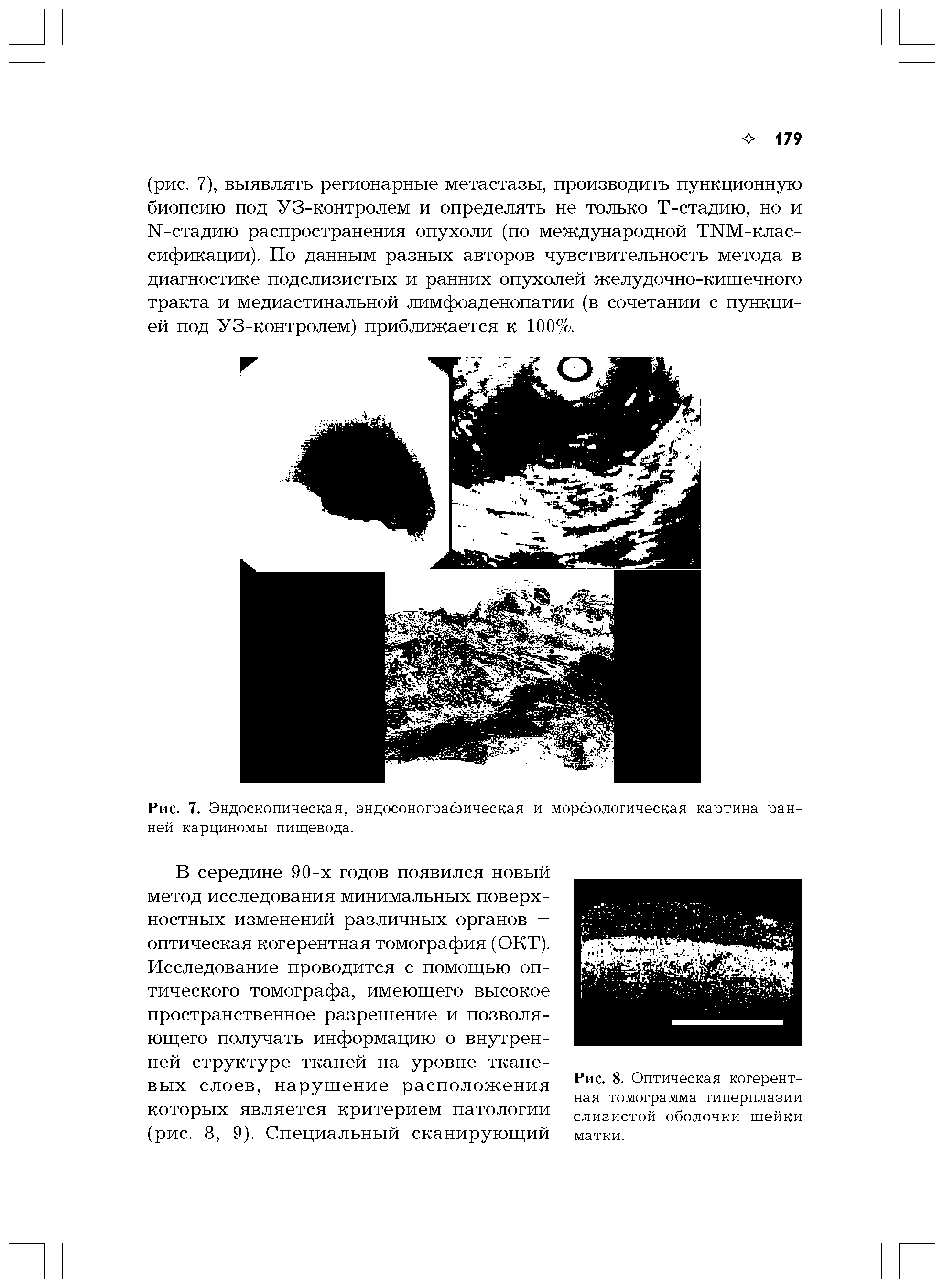 Рис. 7. Эндоскопическая, эндосонографическая и морфологическая картина ранней карциномы пищевода.