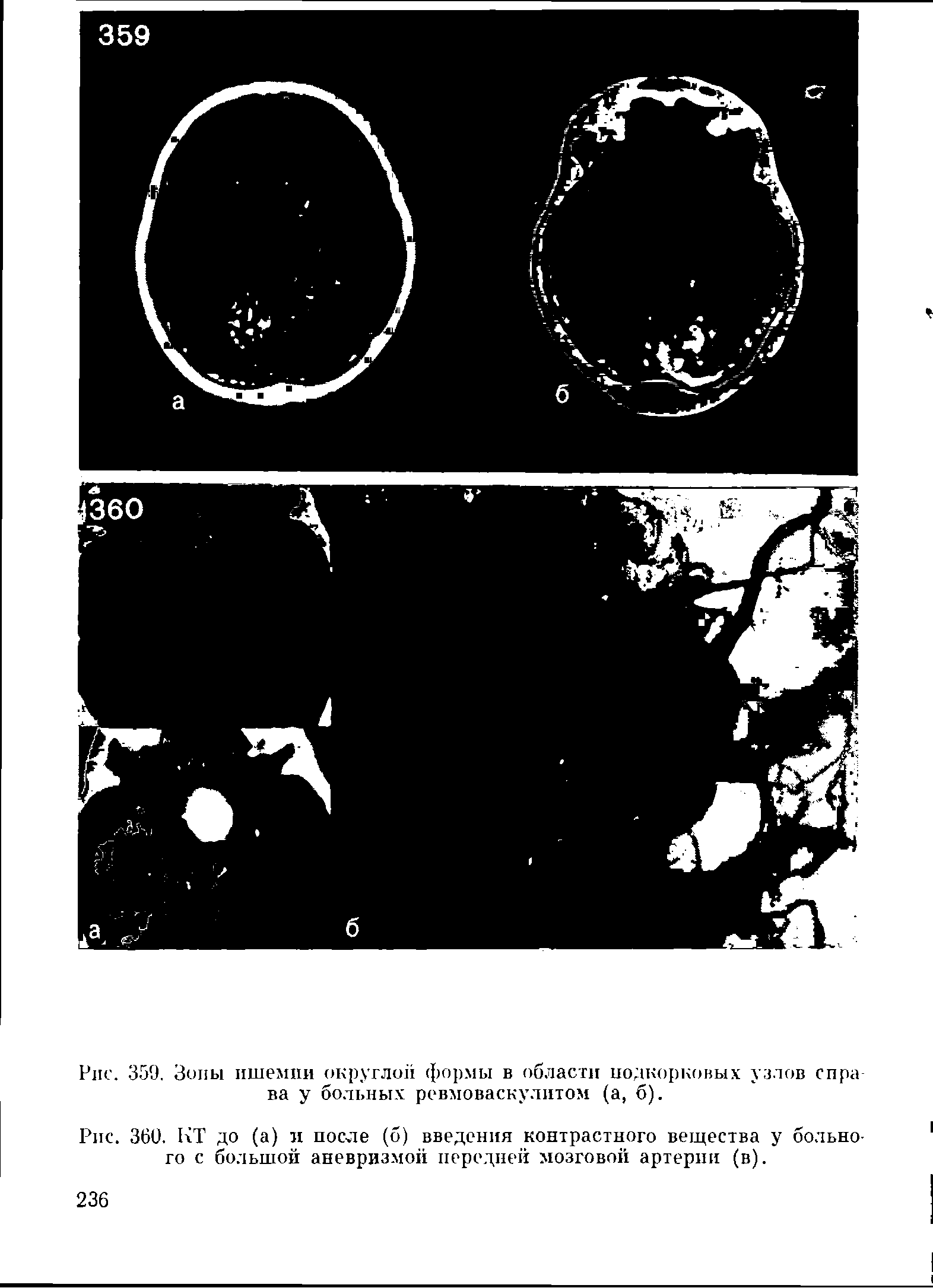 Рис. 360. КТ до (а) и после (б) введения контрастного вещества у больного с большой аневризмой передней мозговой артерии (в).
