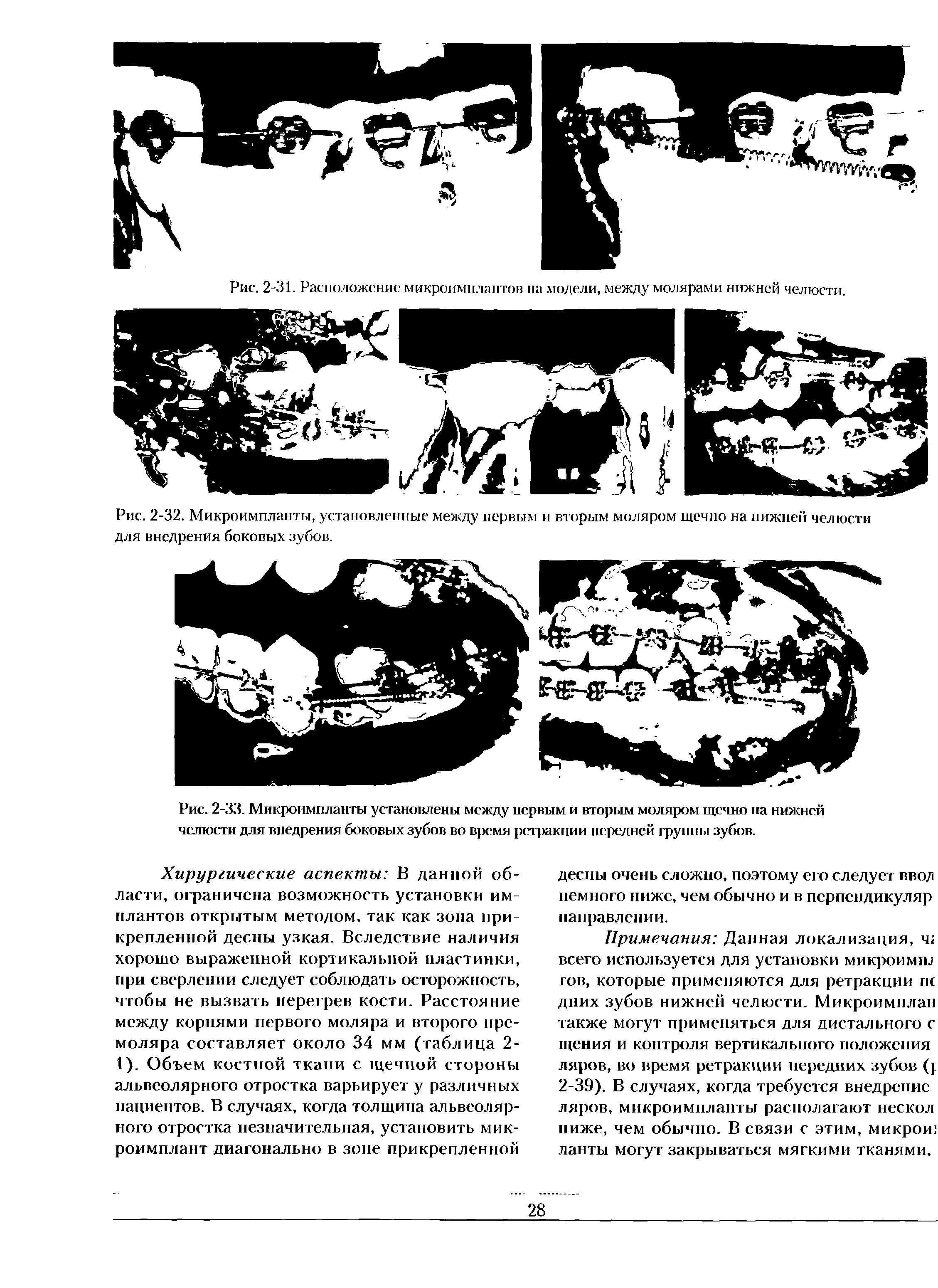 Рис. 2-33. Микроимпланты установлены между первым и вторым моляром щечно на нижней челюсти для внедрения боковых зубов во время ретракции передней группы зубов.